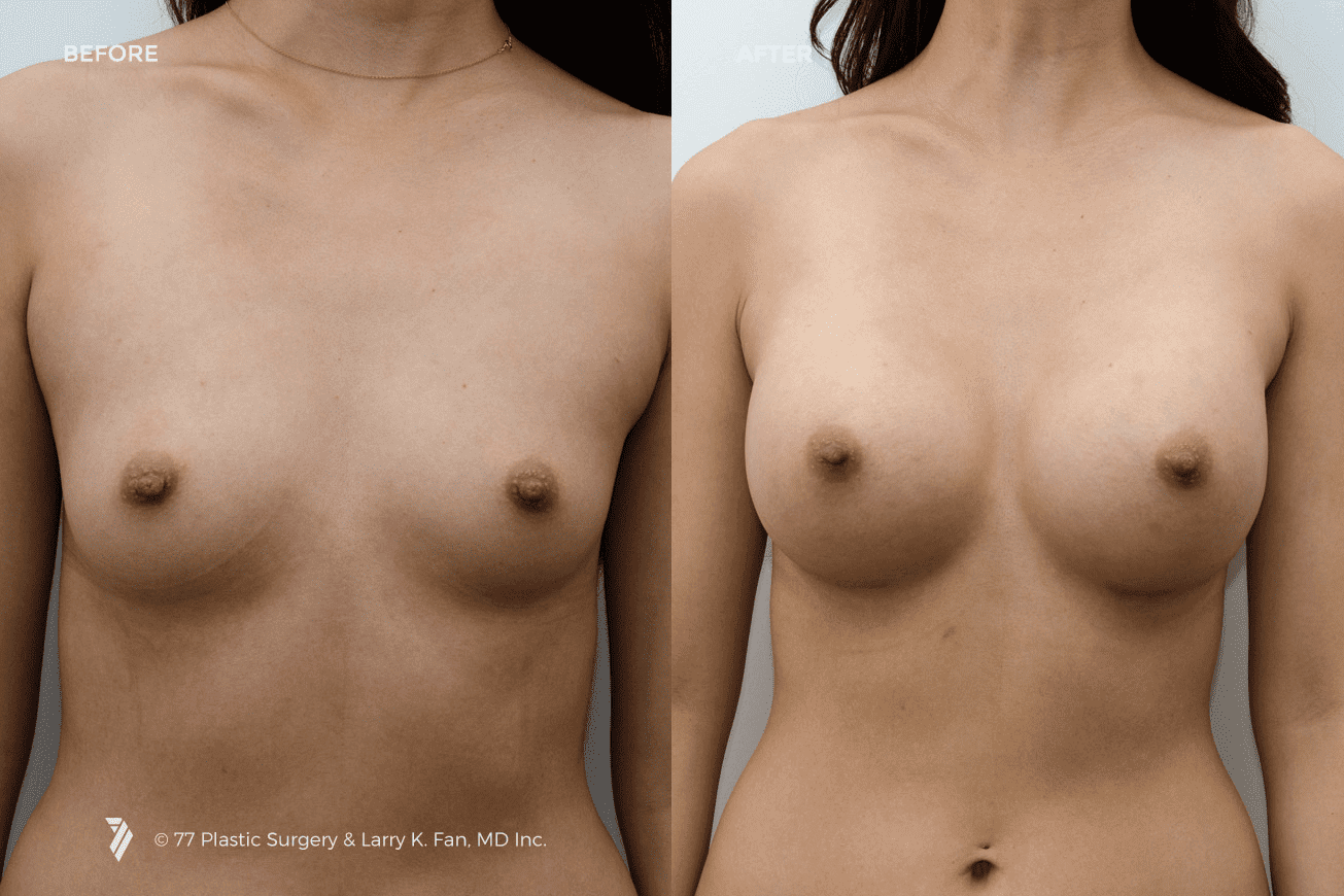 77p/DEV/77-Plastic-Surgery_breast-implants-before-and-after_2.png