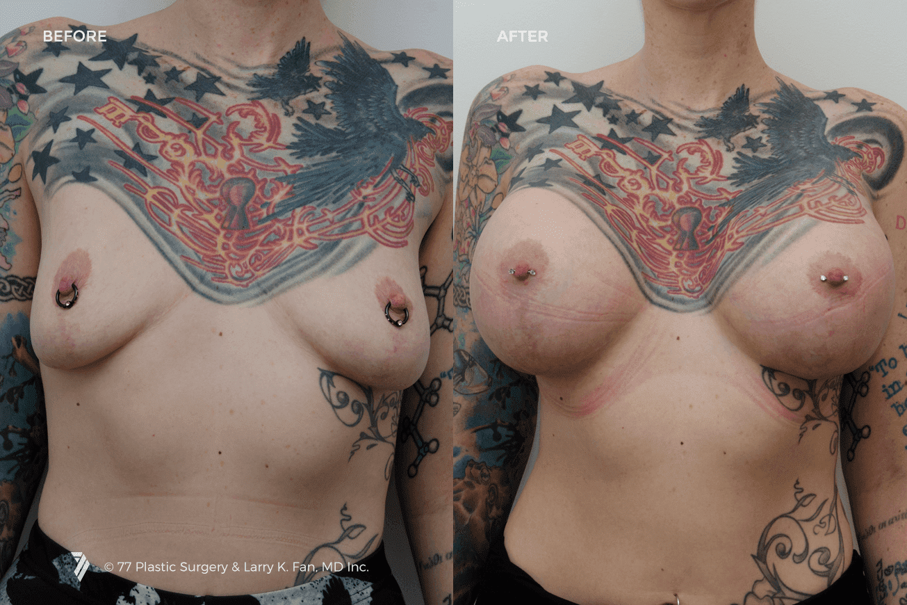 77-Plastic-Surgery_breast-implants-before-and-after_3.png