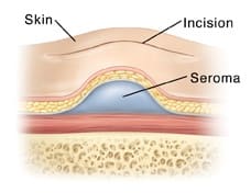 tummy tuck seroma