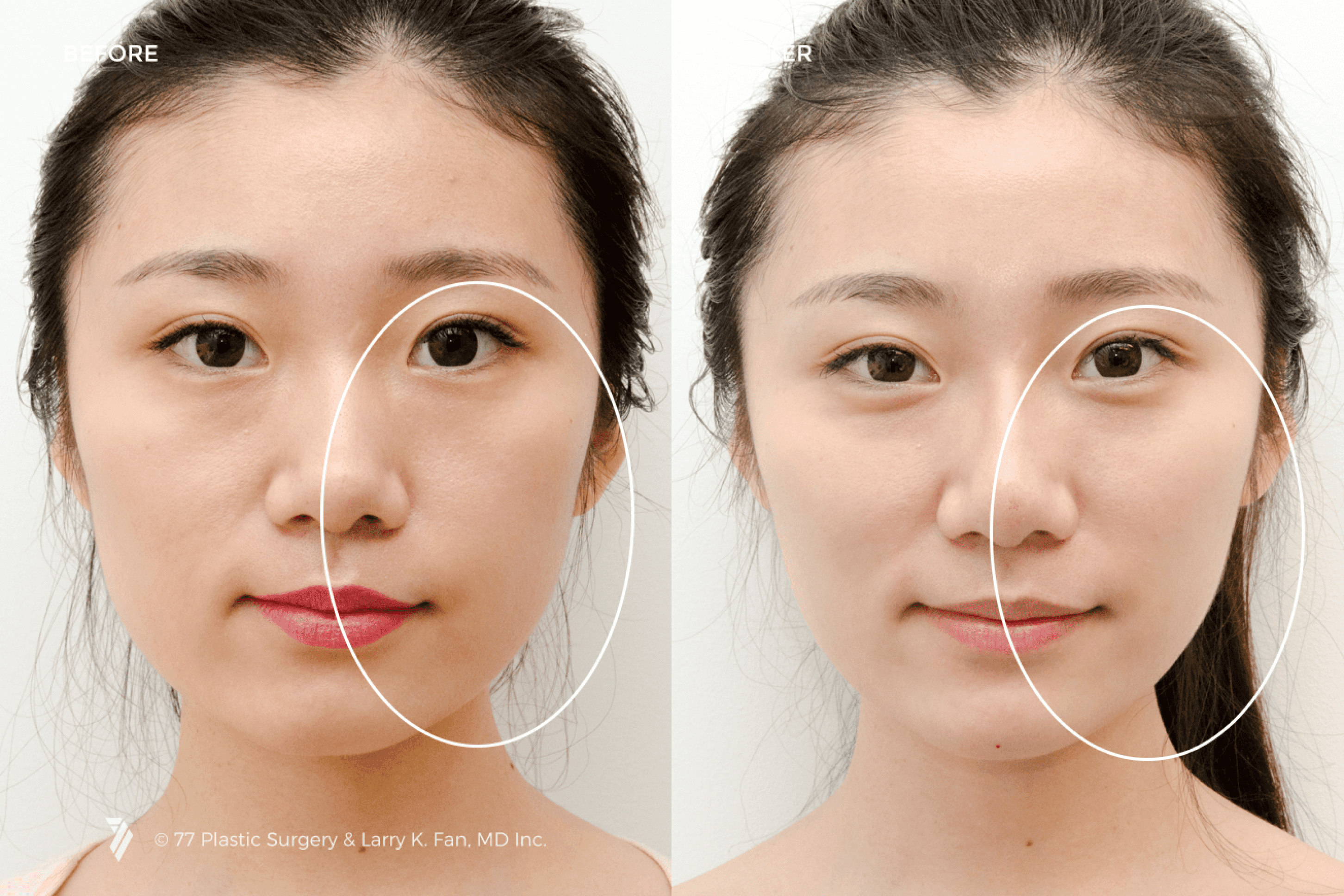 before and after of Asian Facial Contouring patient