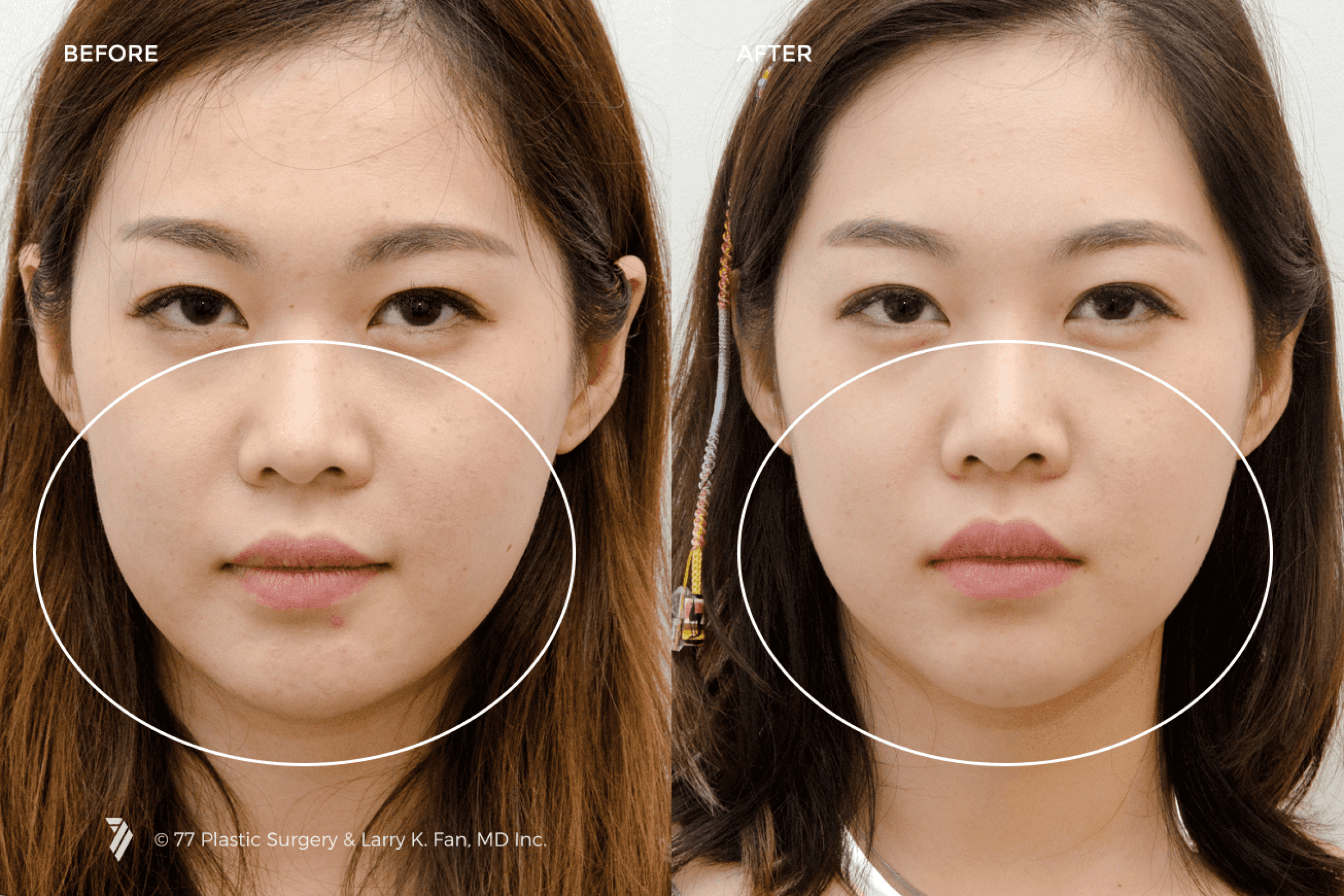 before and after procedure comparison