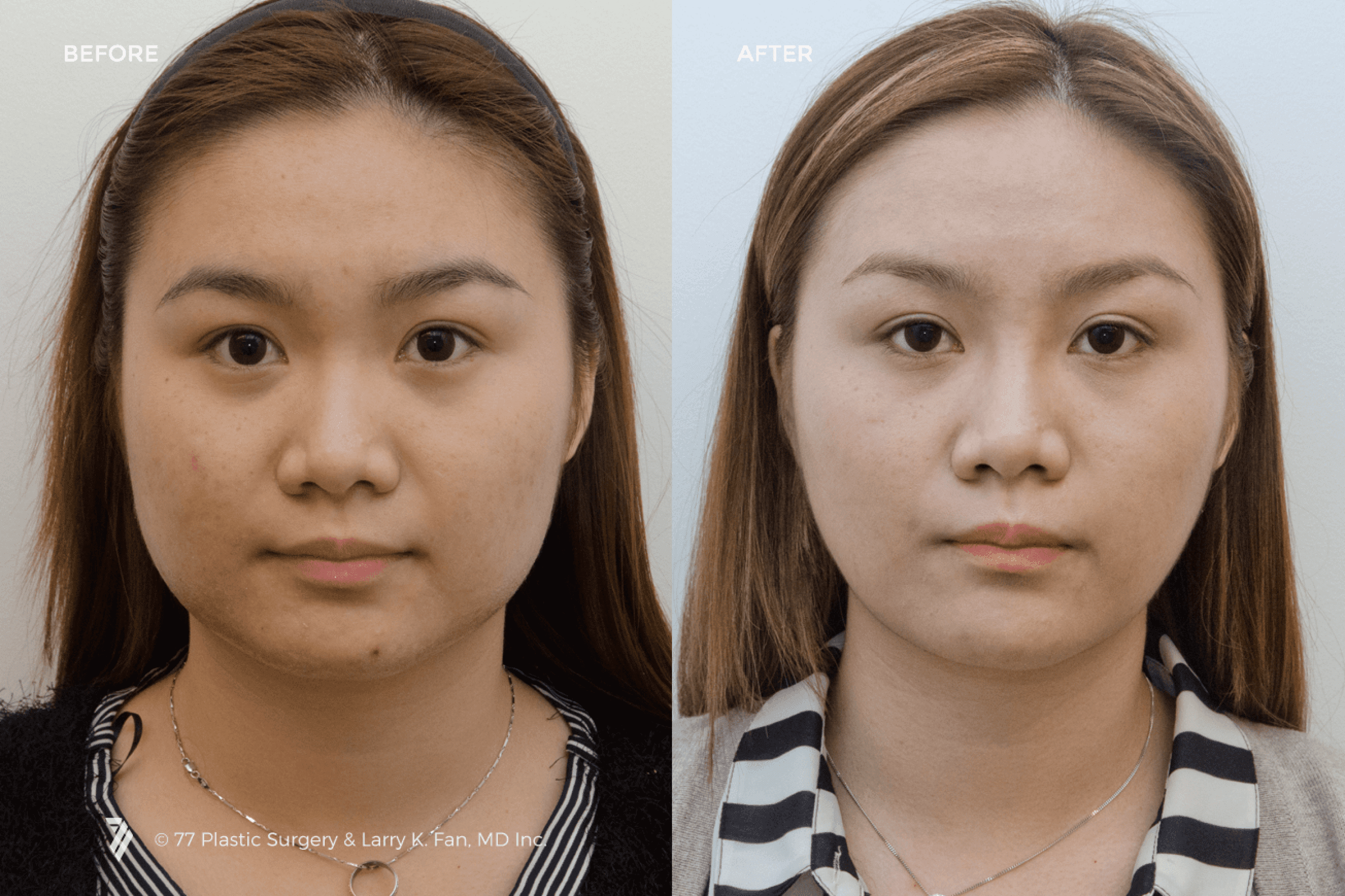 before and after procedure comparison