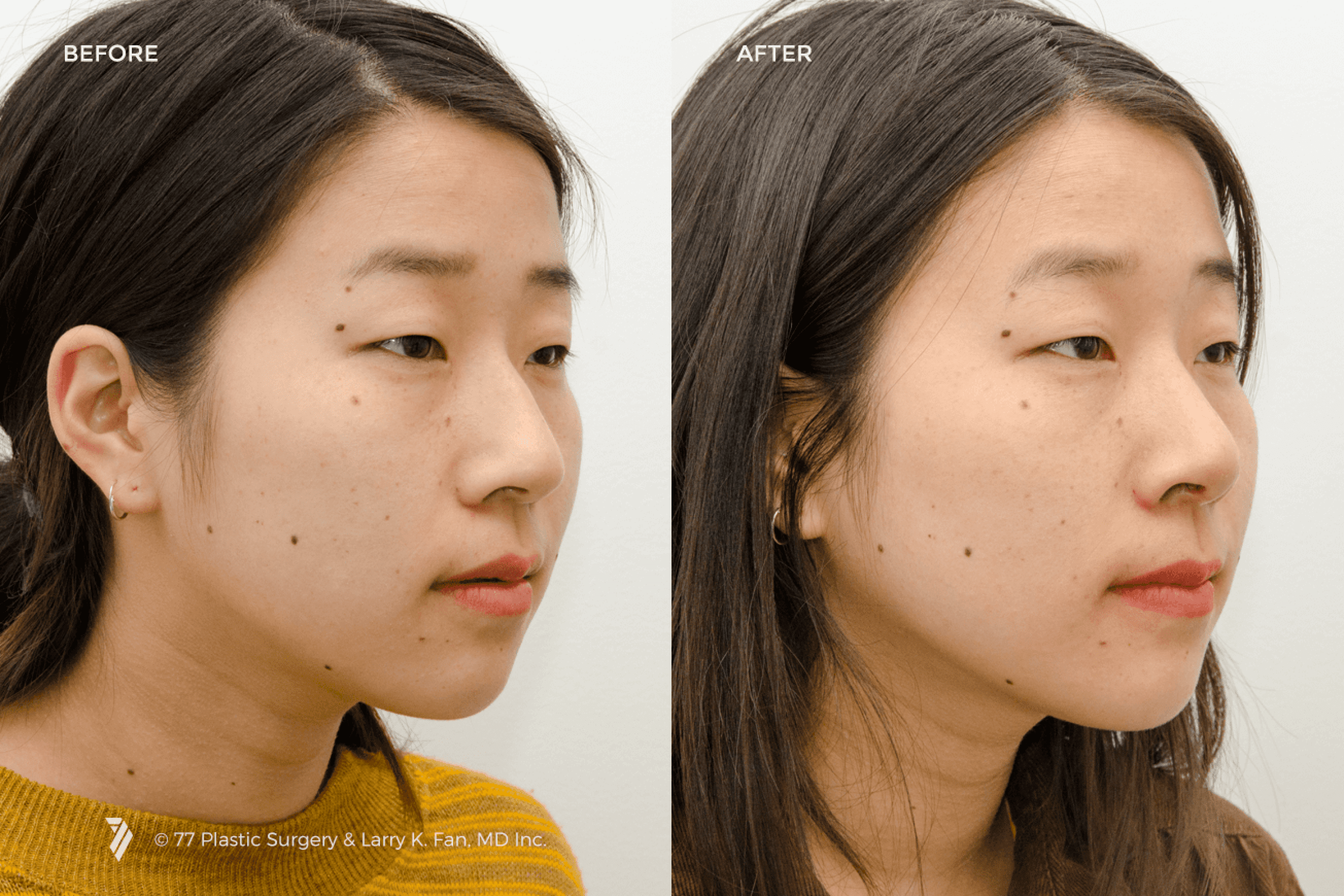 before and after of Asian Nose Reshaping patient