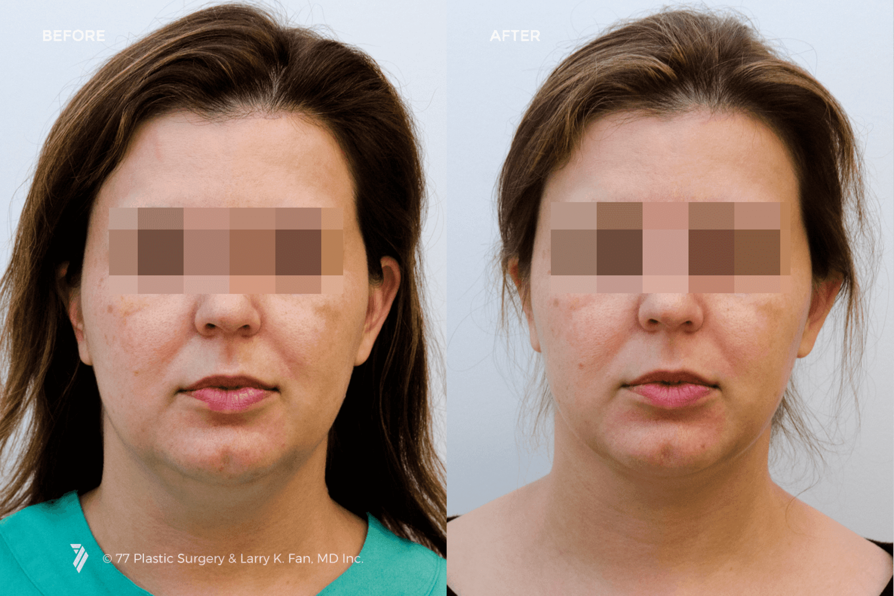 before and after procedure comparison