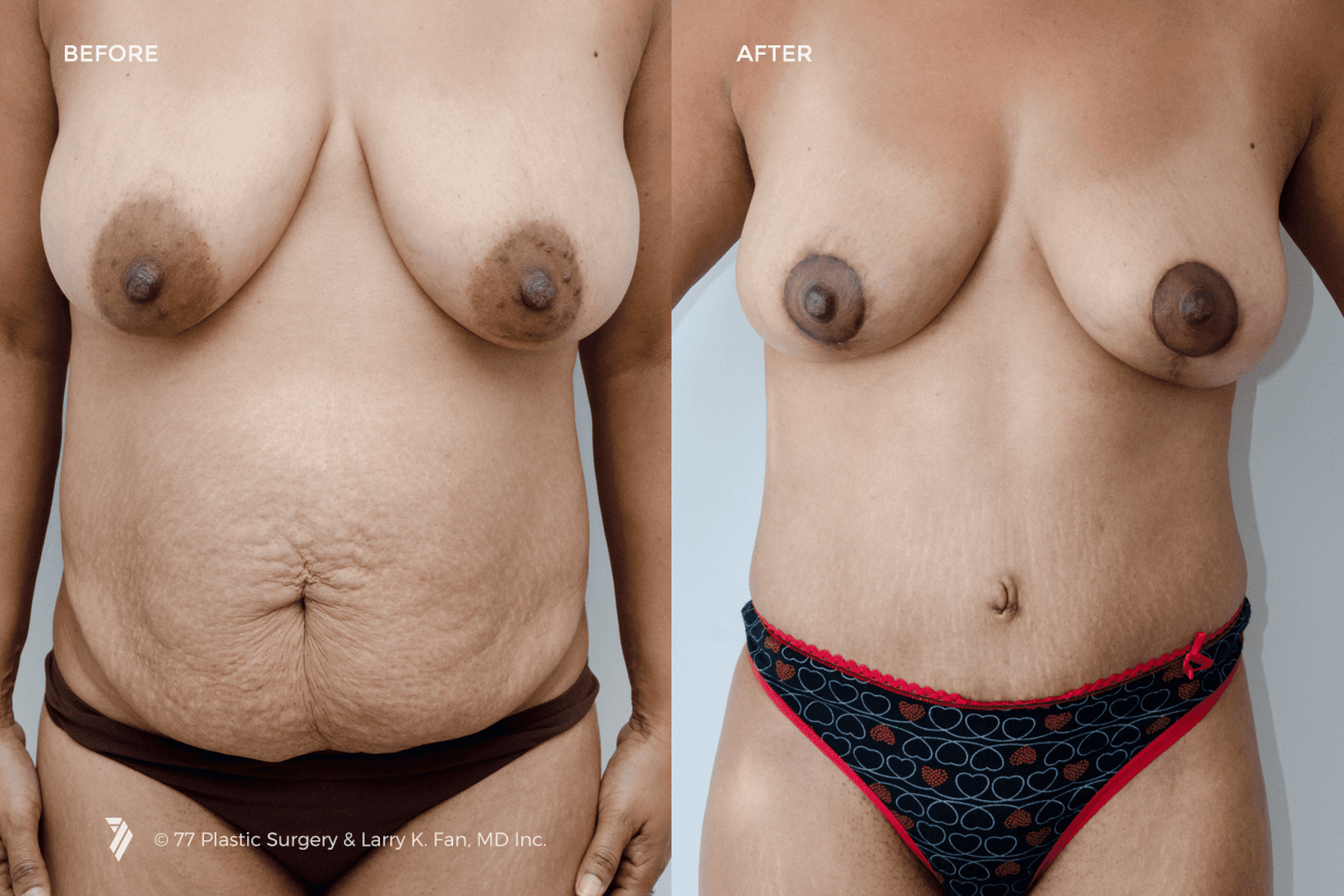 before and after procedure comparison