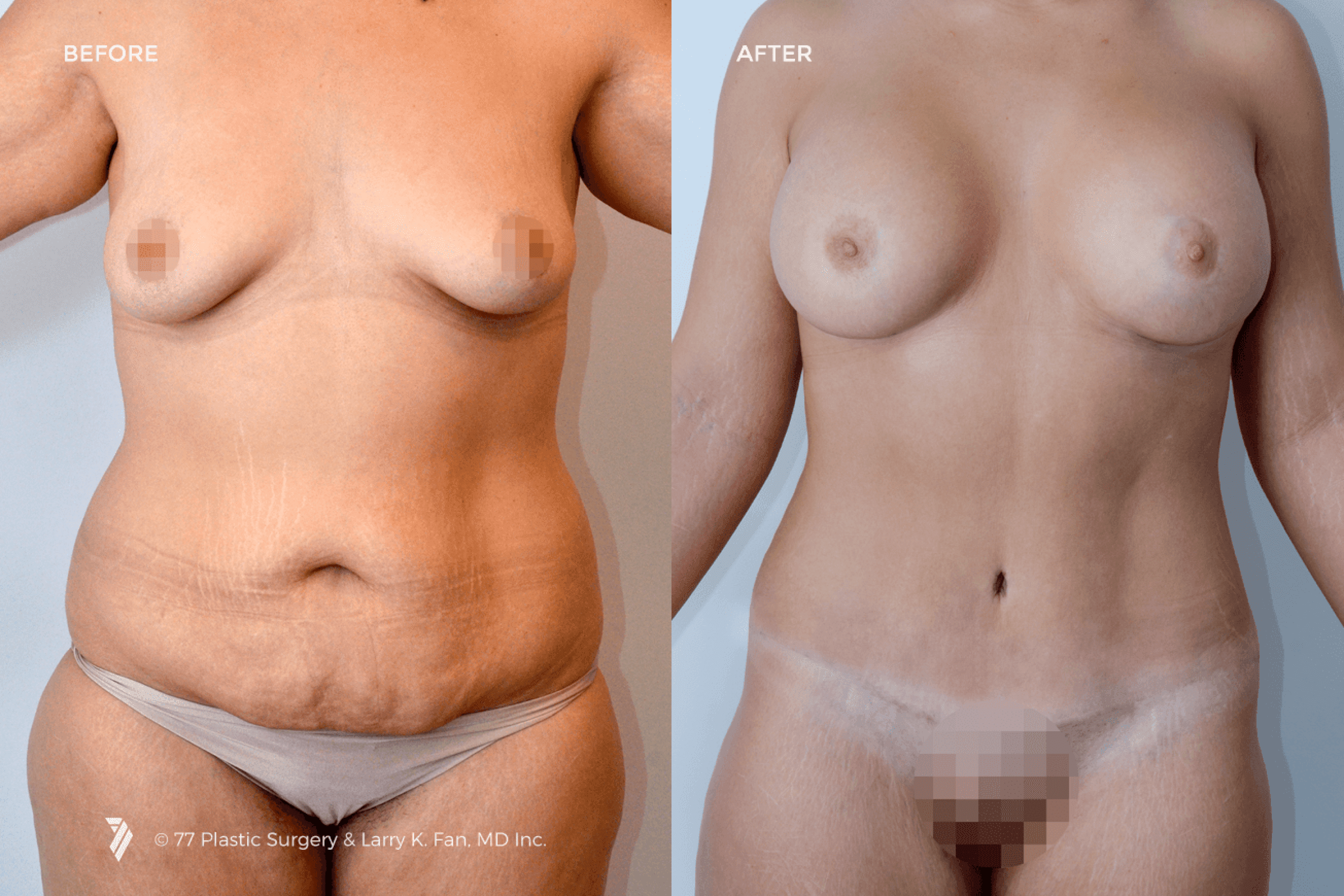 before and after procedure comparison