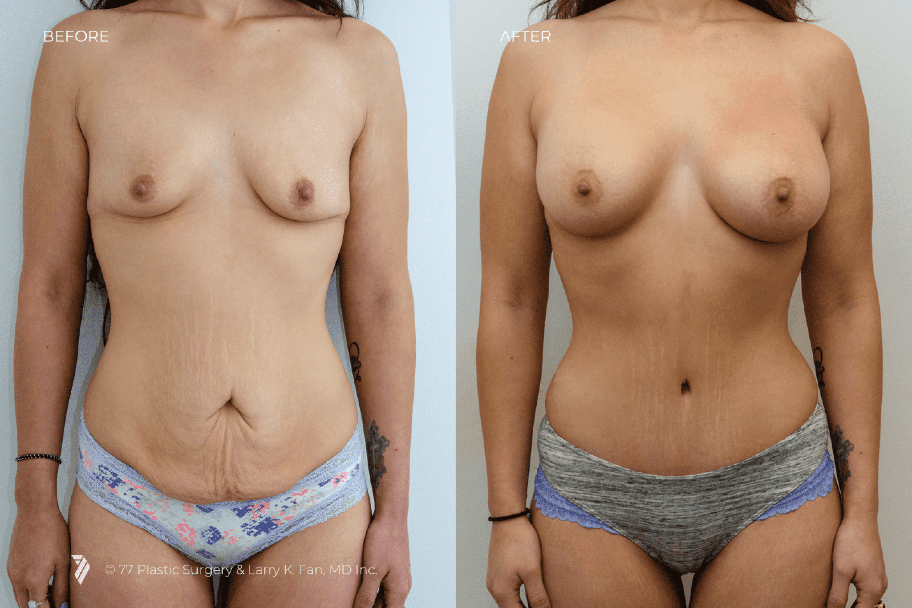 before and after procedure comparison