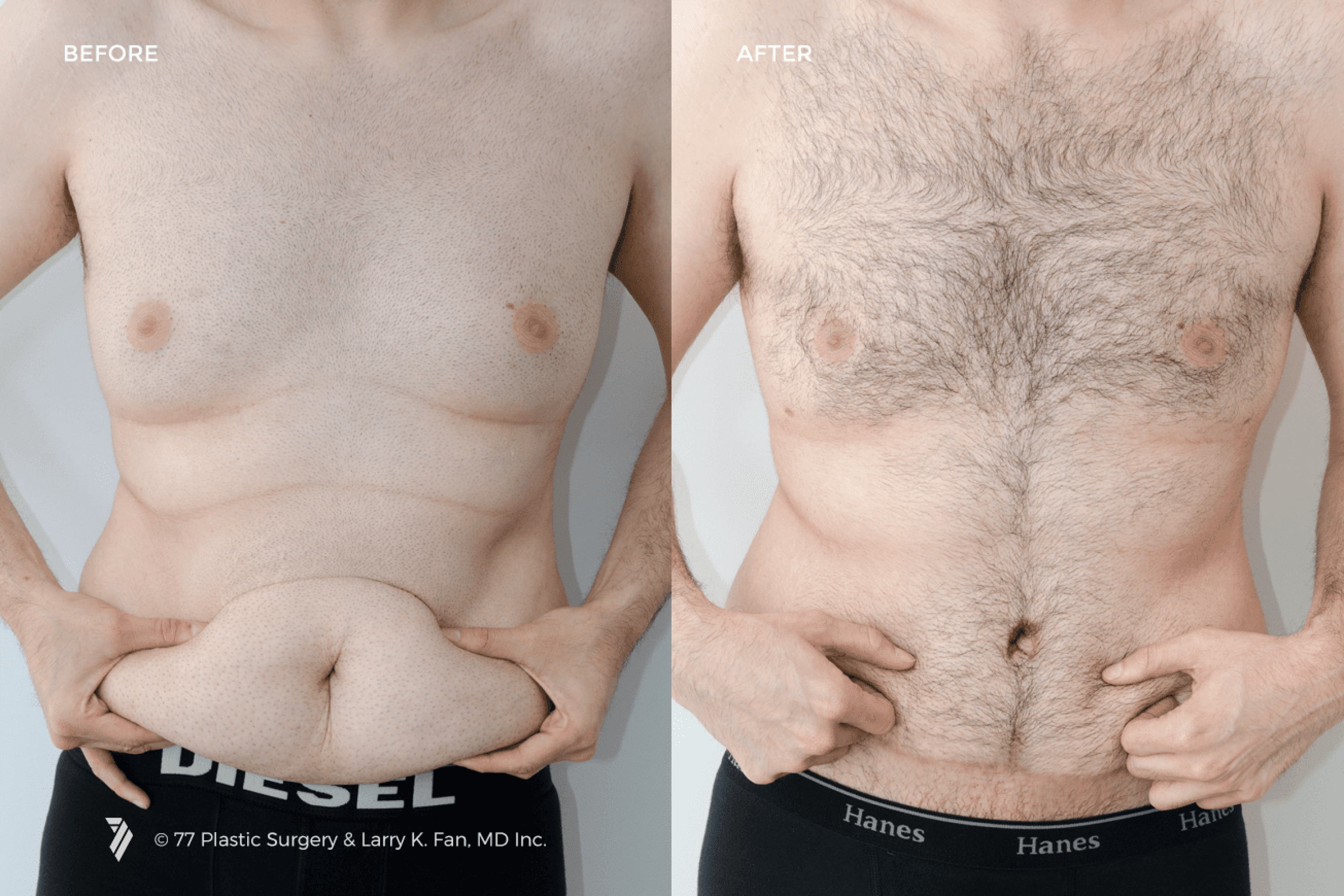 before and after procedure comparison