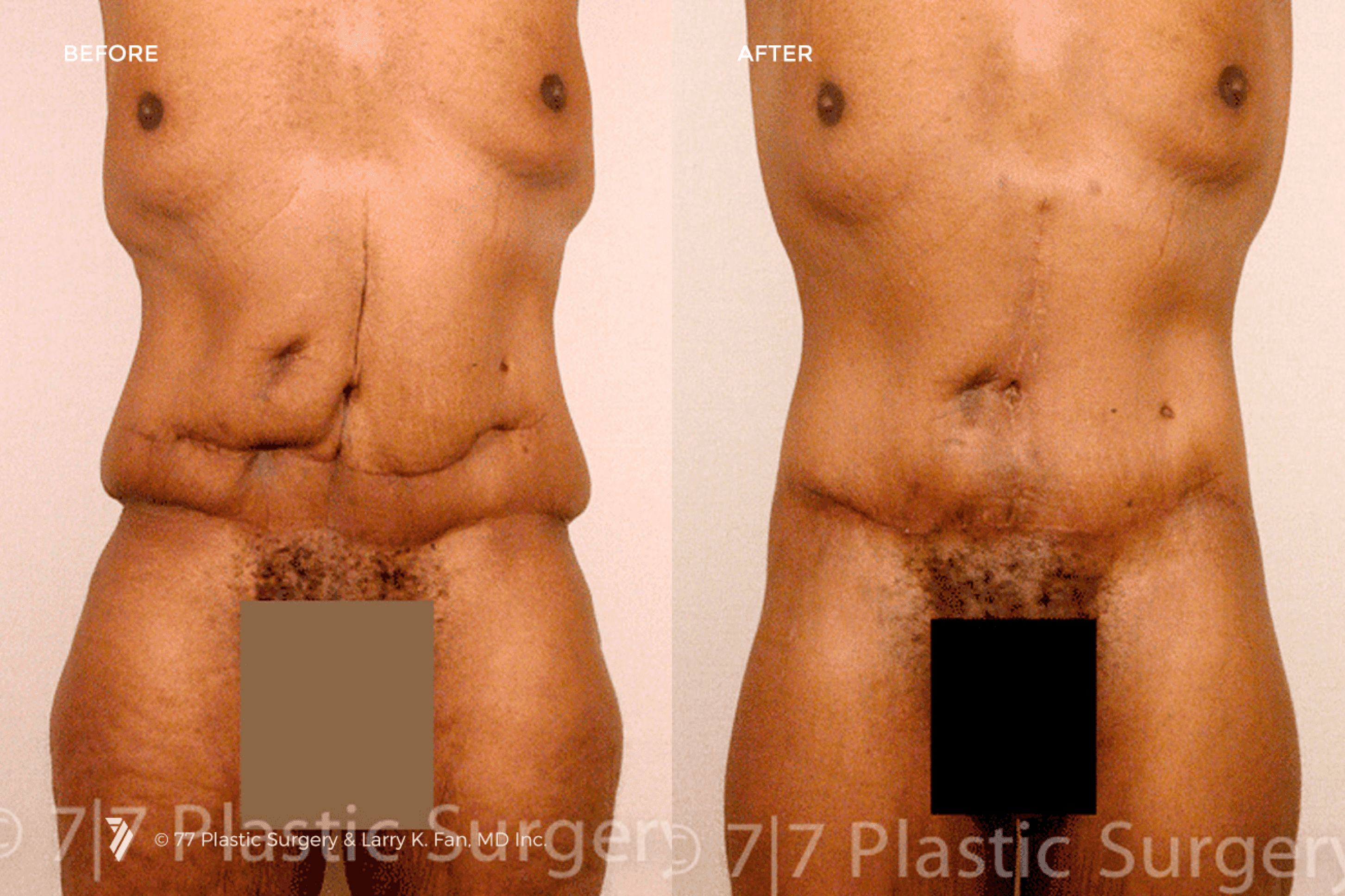 before and after procedure comparison