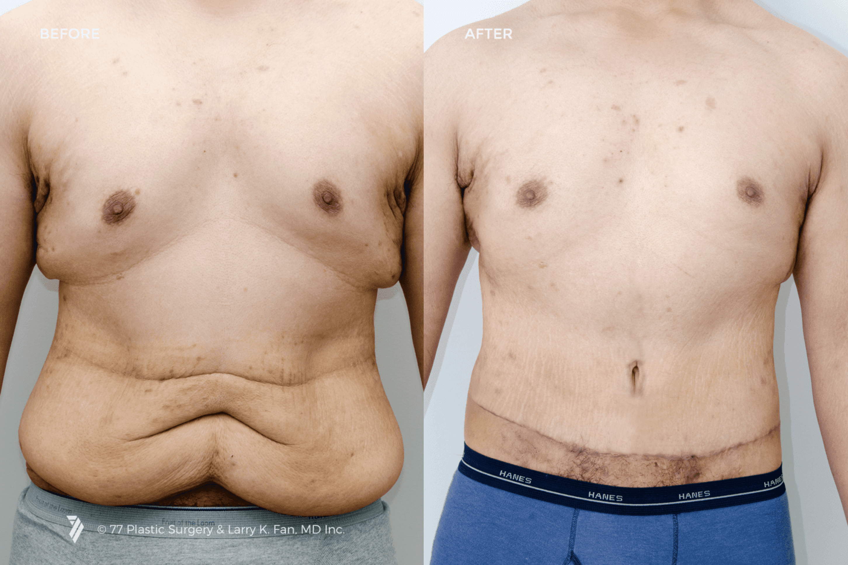 before and after procedure comparison