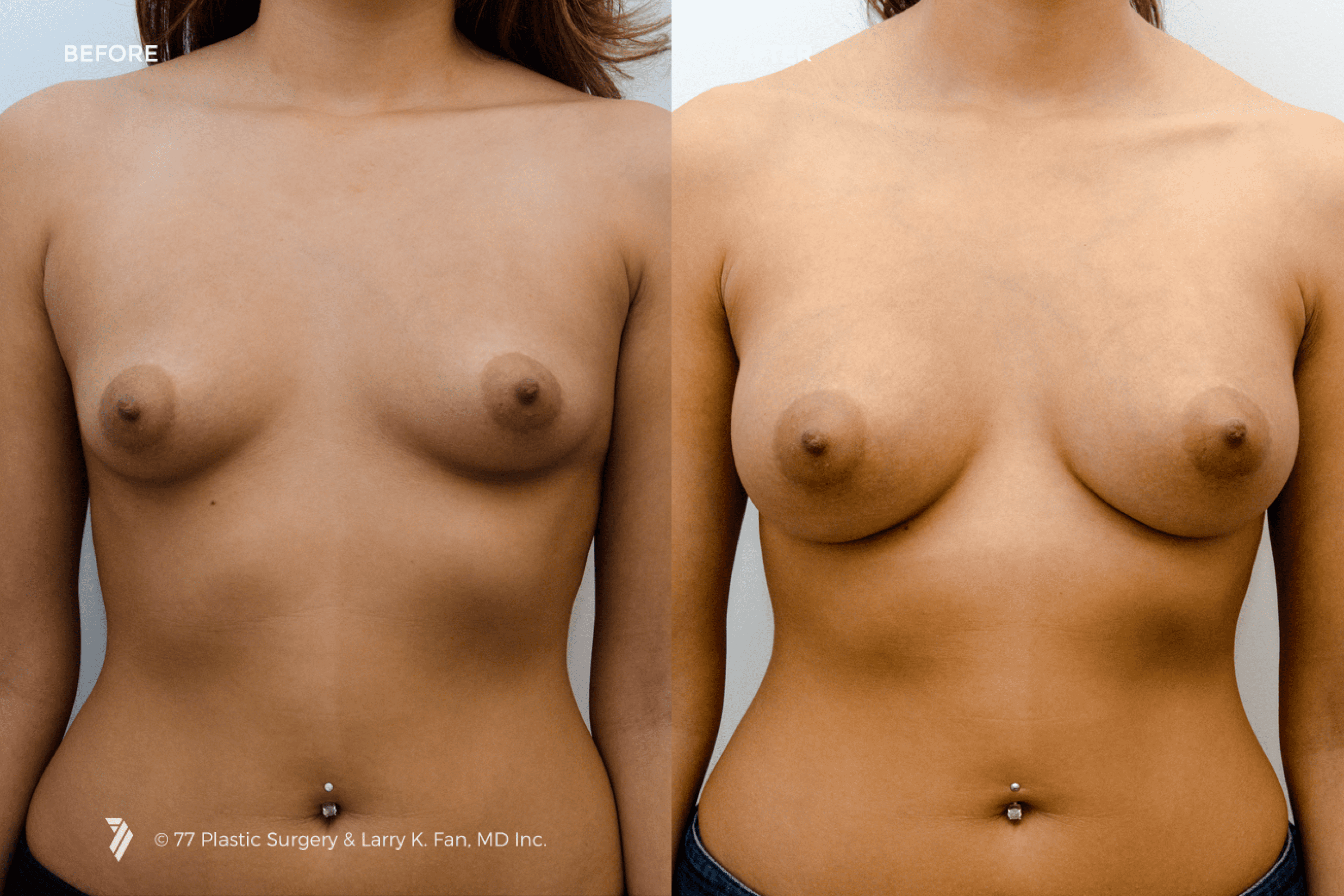 before and after procedure comparison