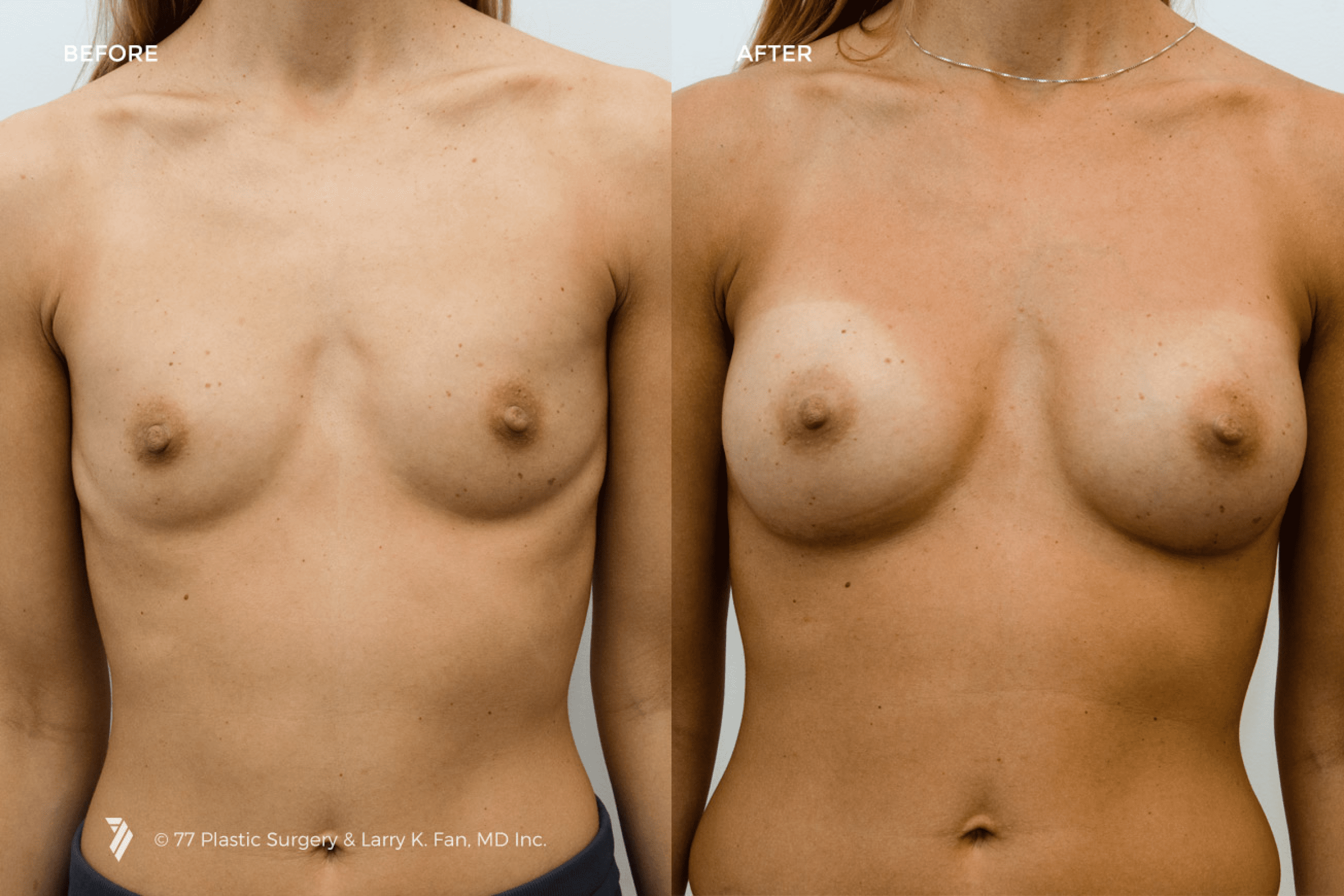 before and after procedure comparison