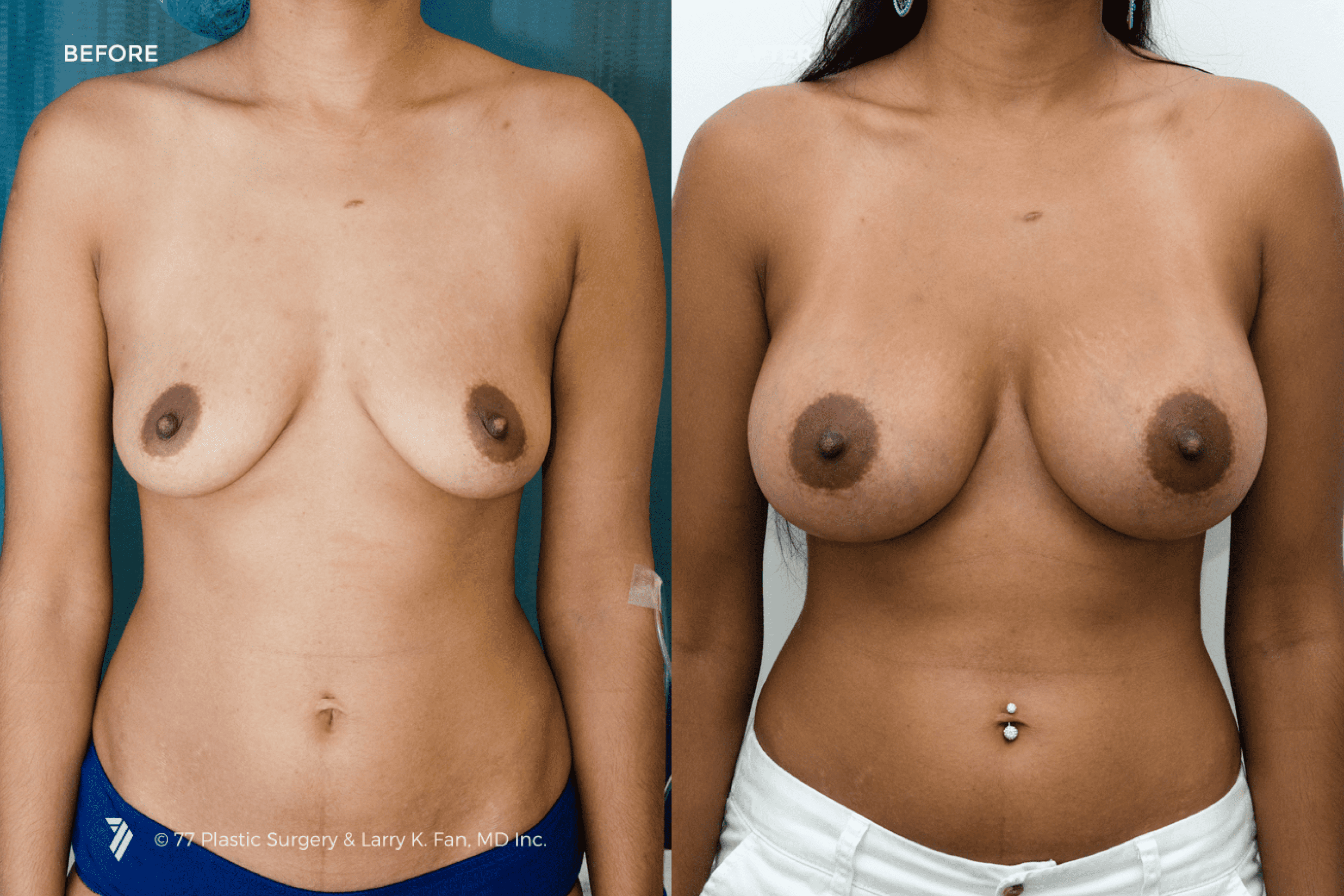 before and after procedure comparison