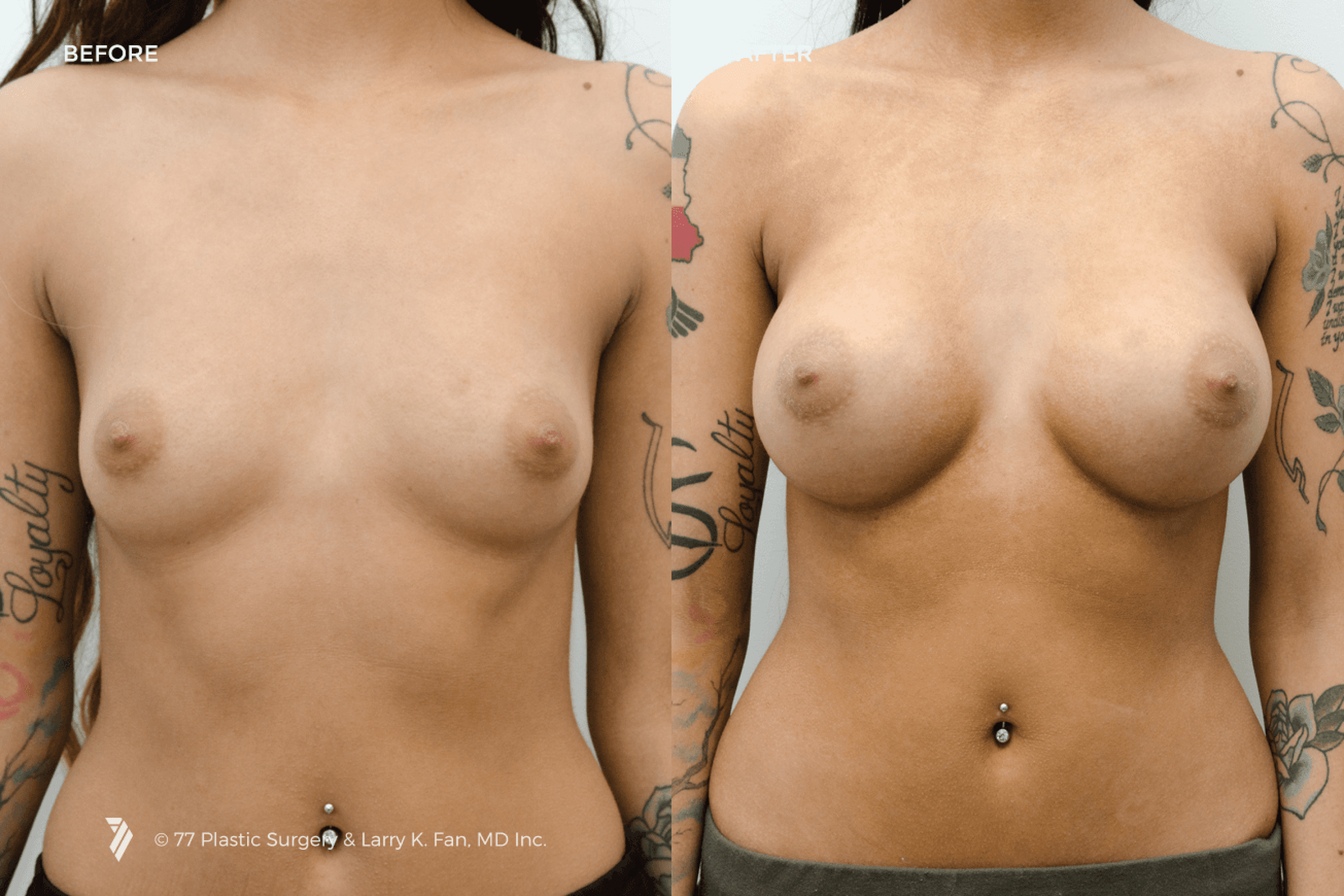 before and after procedure comparison