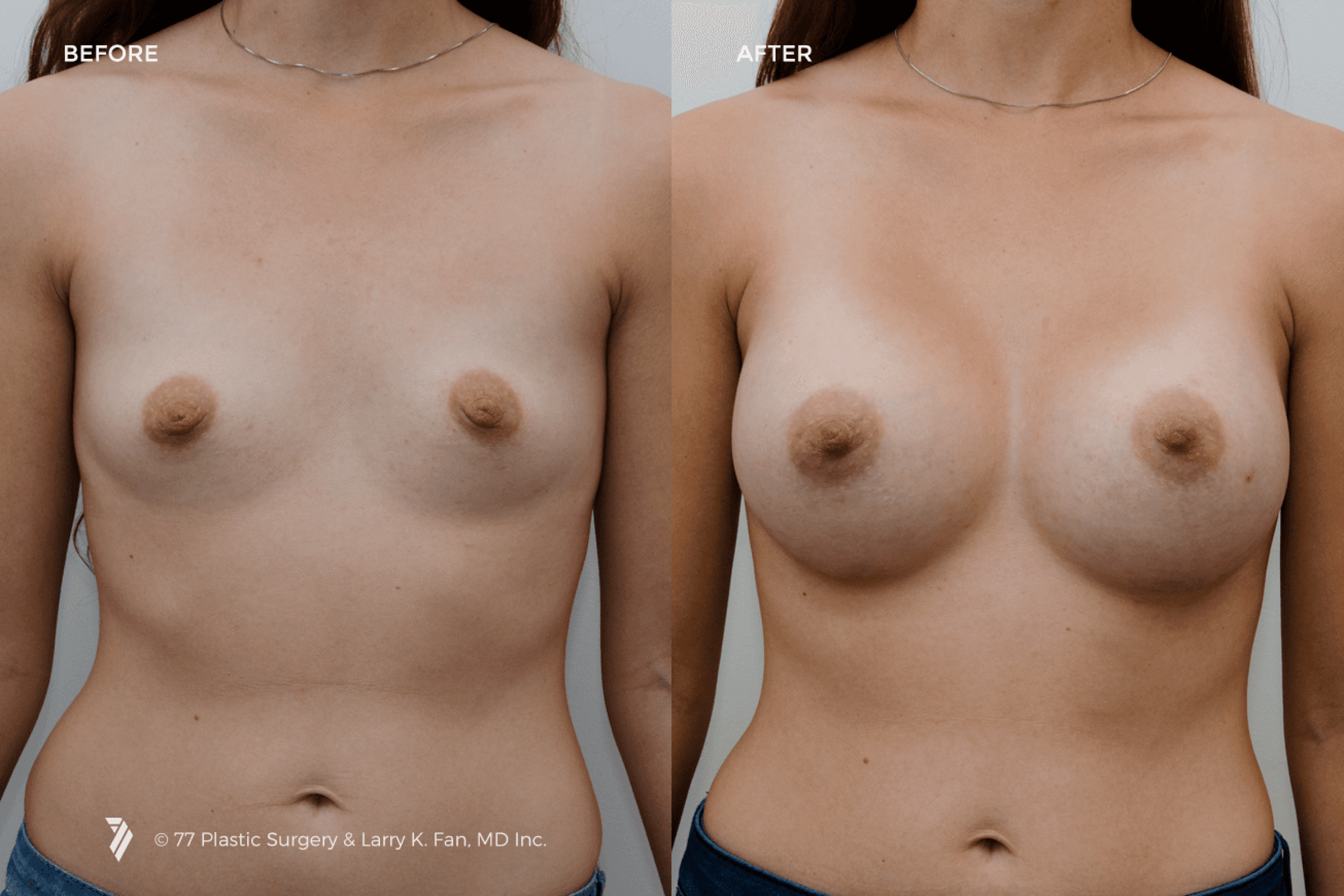 before and after procedure comparison