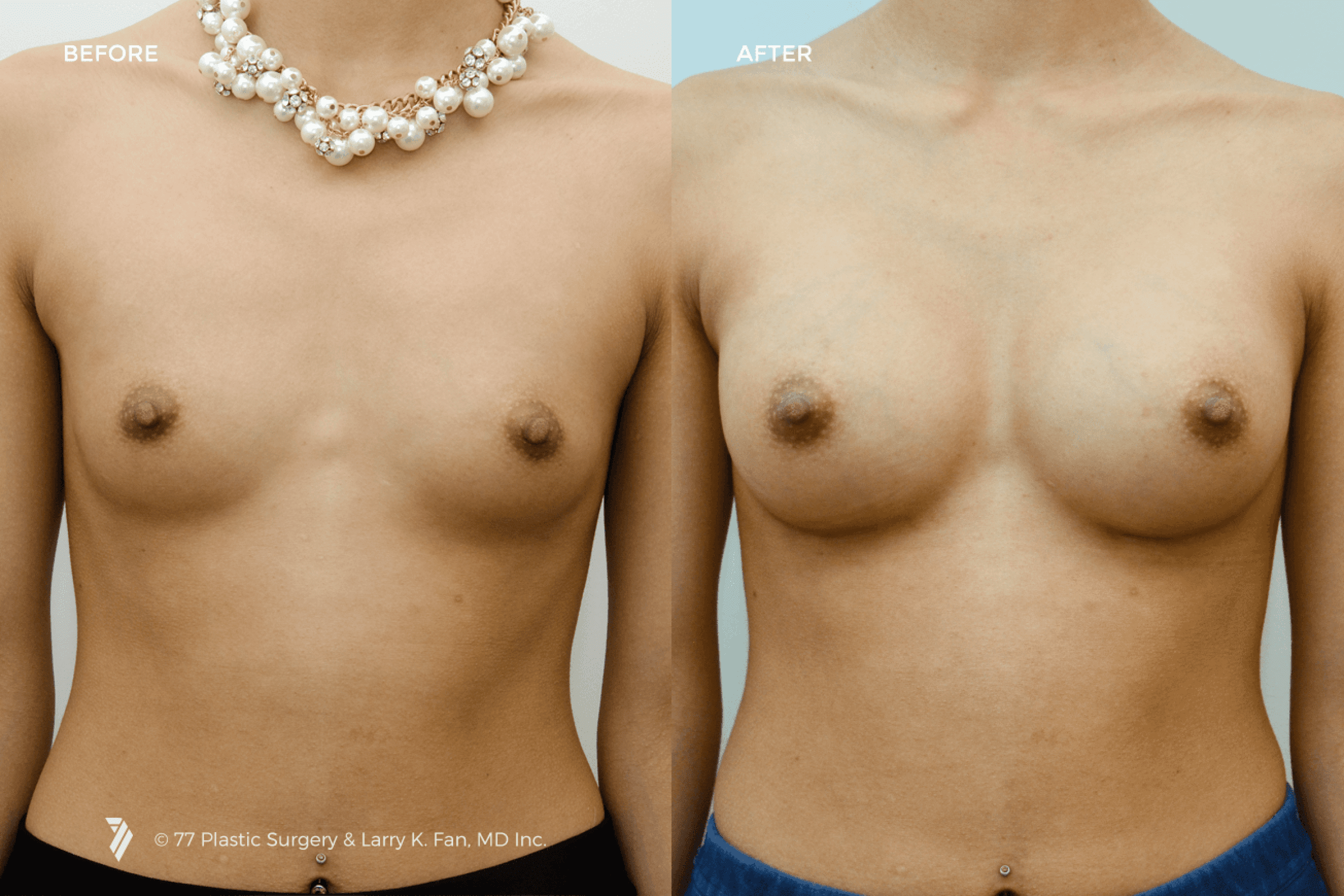 before and after procedure comparison