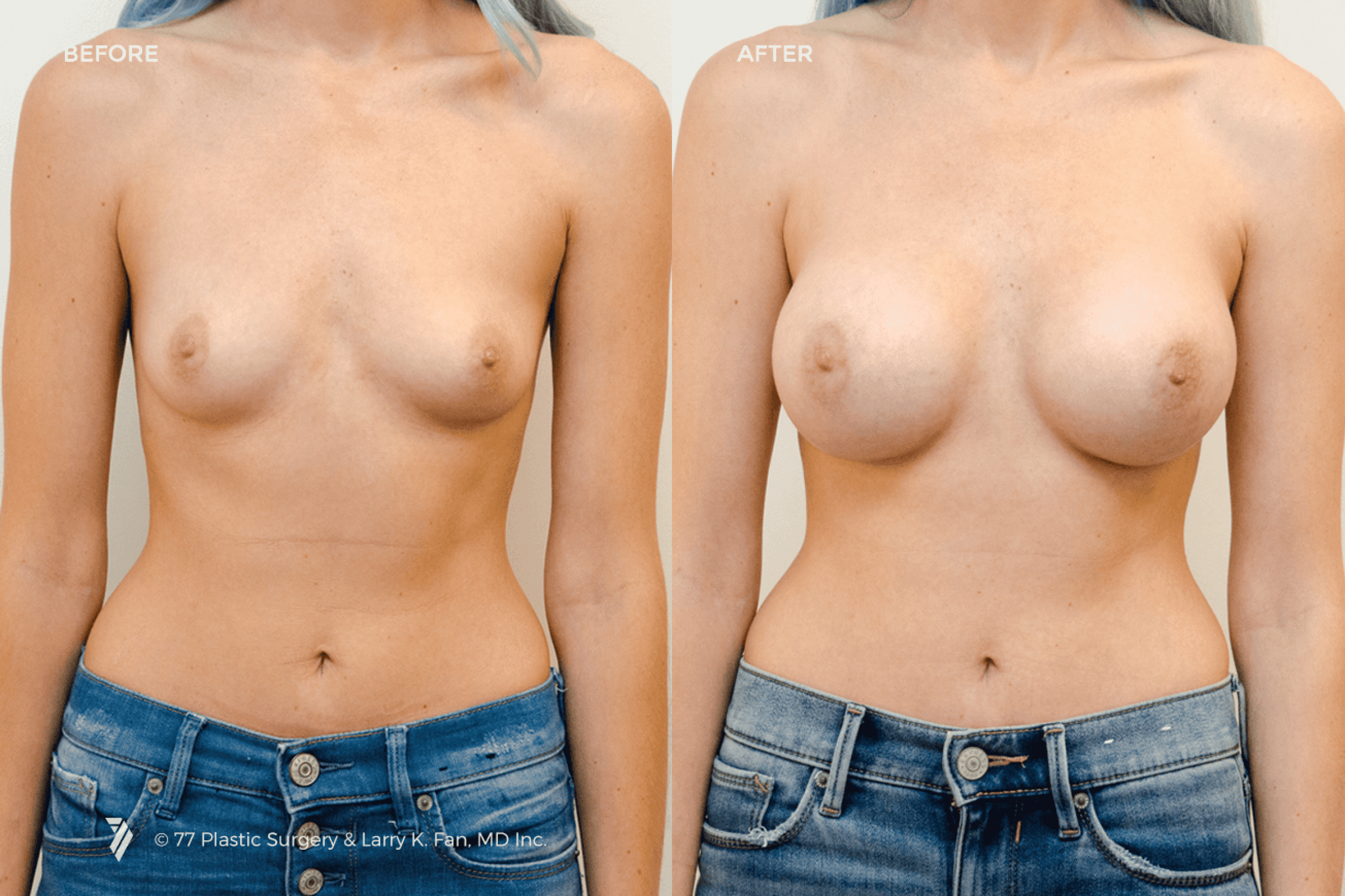 before and after procedure comparison