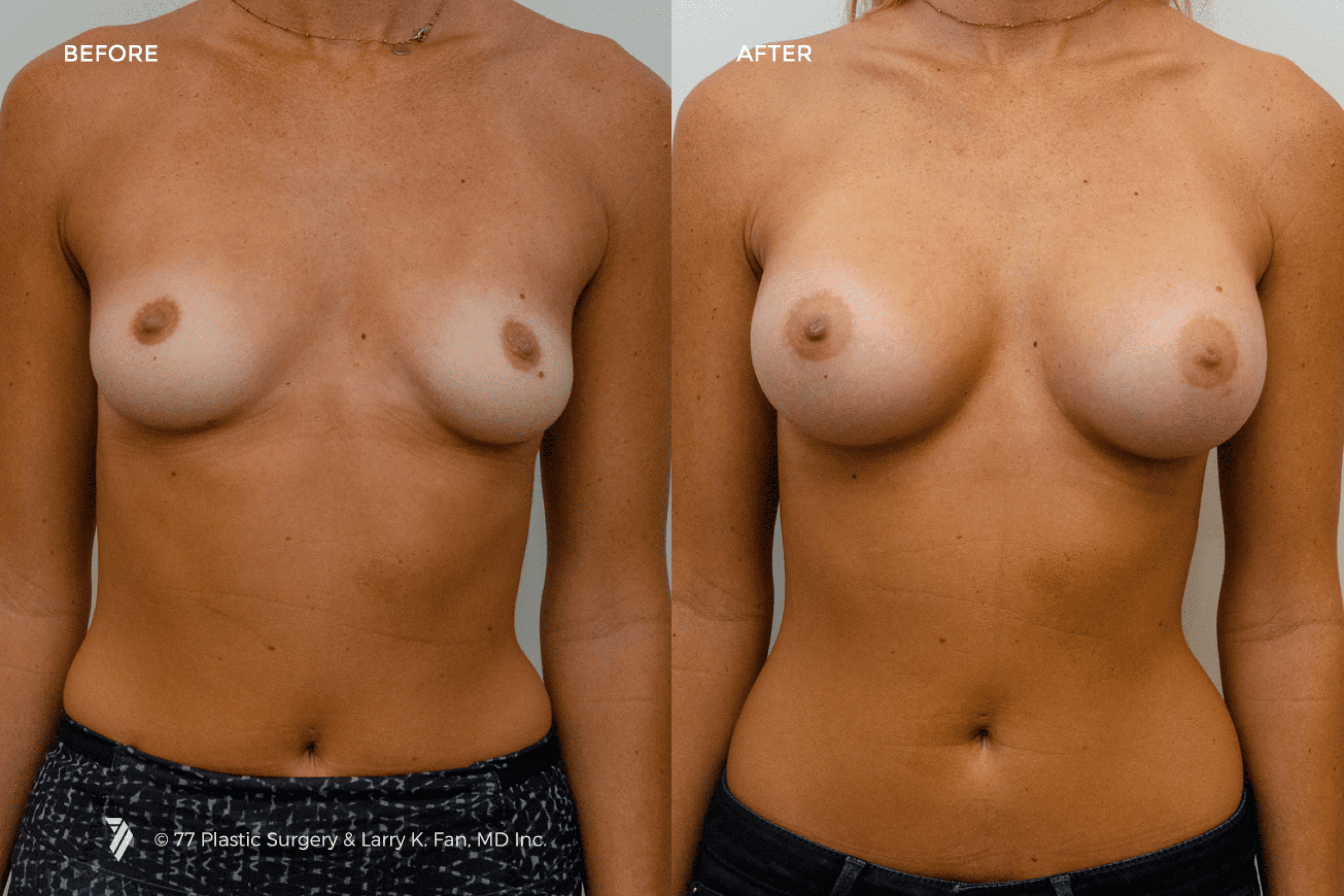 before and after procedure comparison