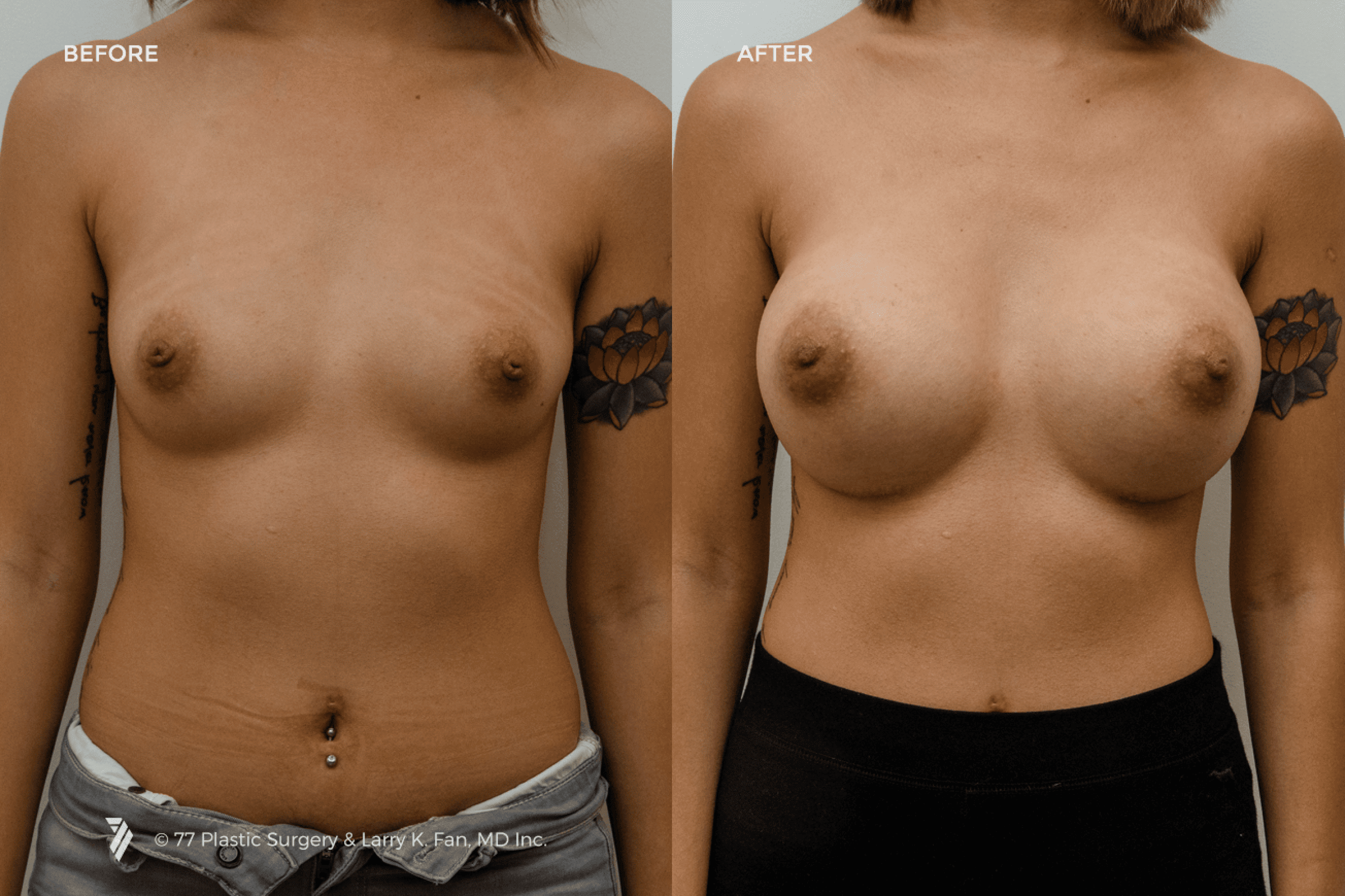 before and after procedure comparison