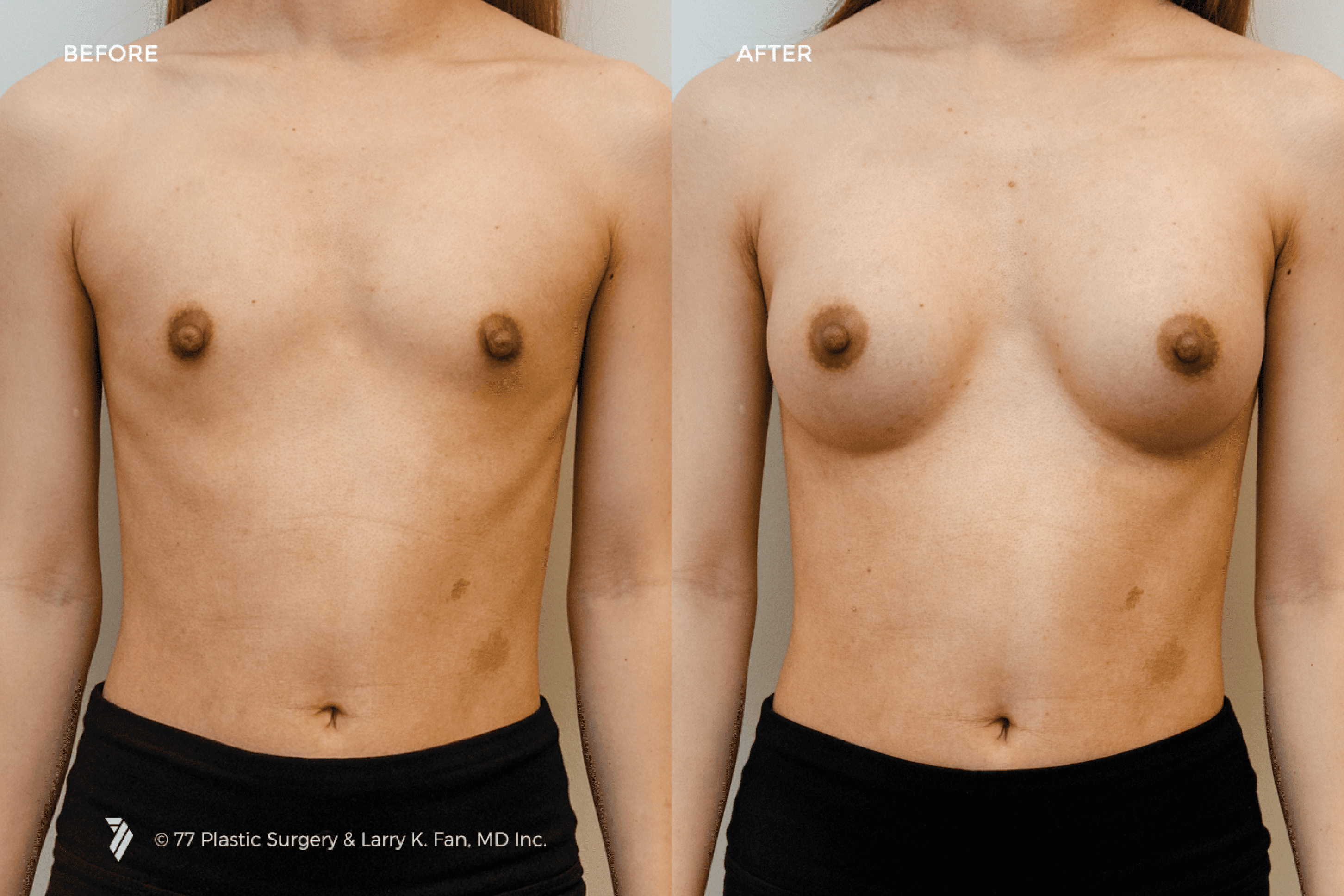 before and after procedure comparison