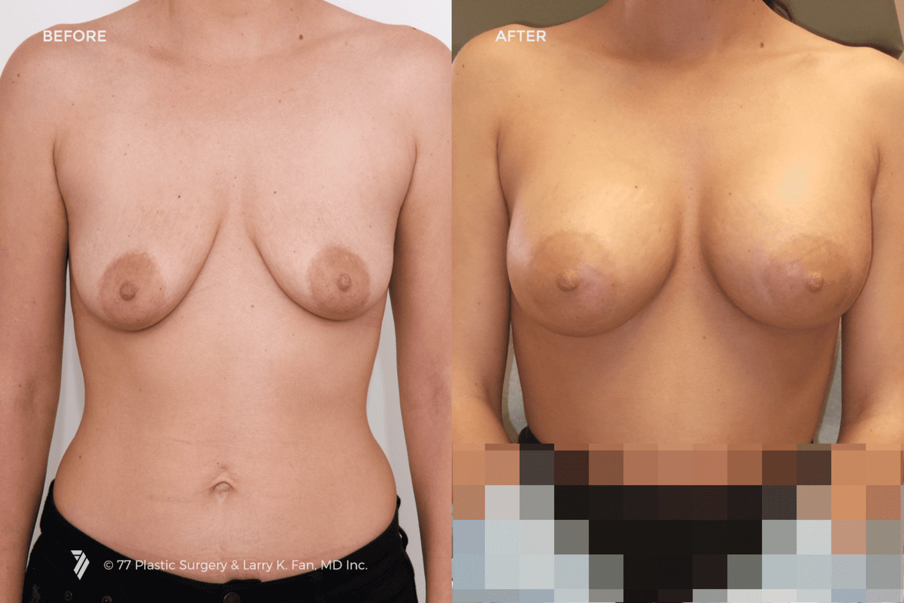 before and after procedure comparison