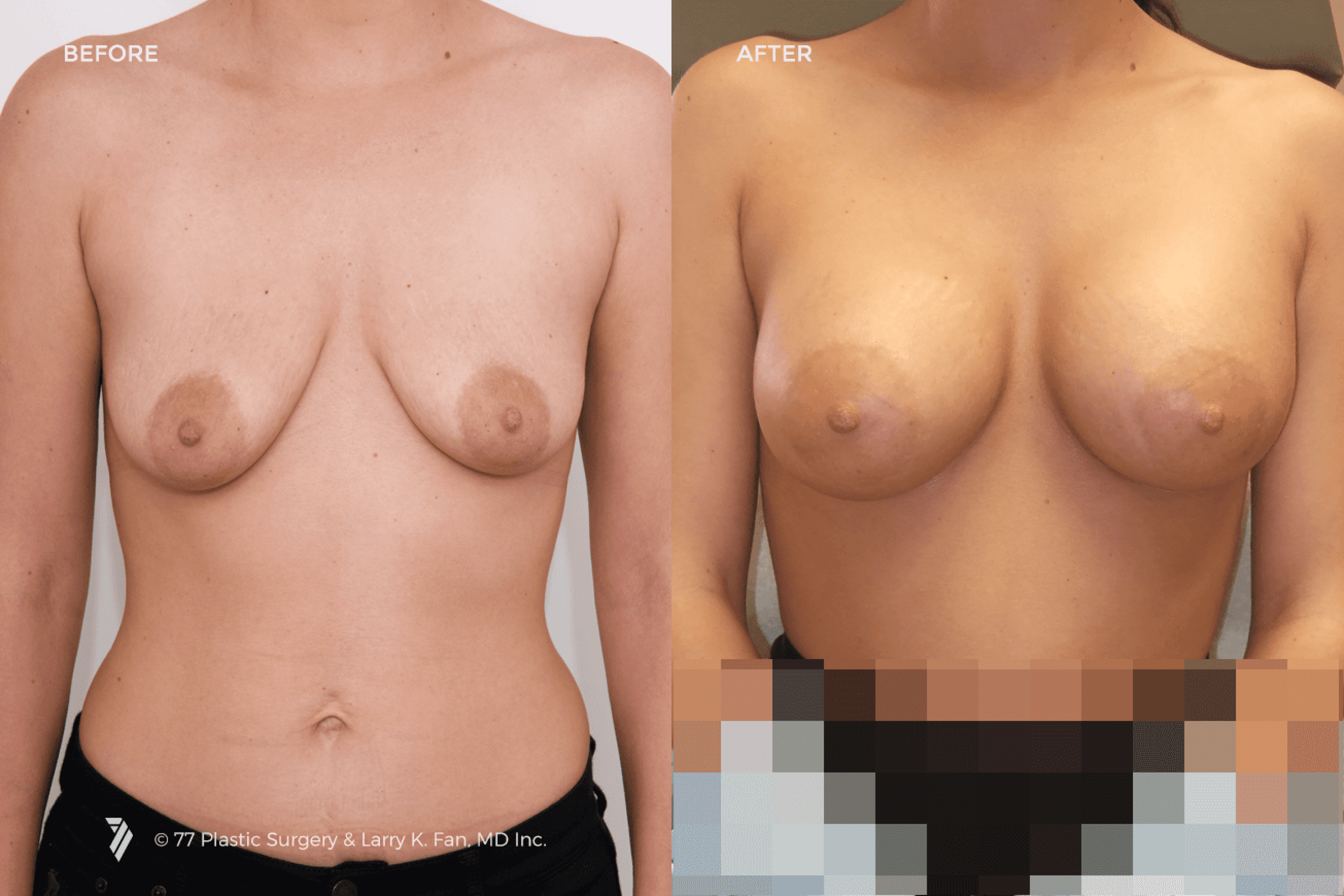 before and after procedure comparison