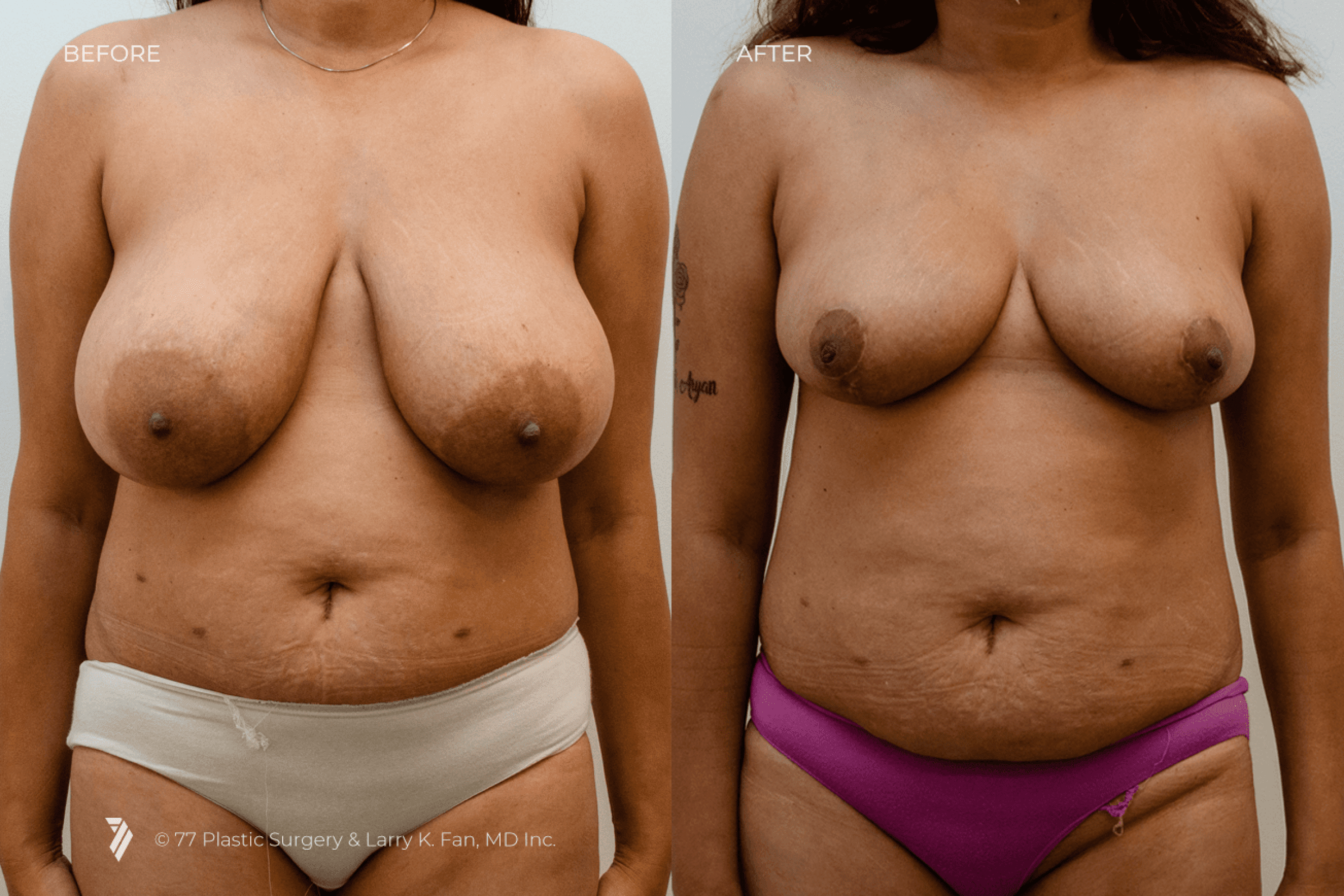 before and after procedure comparison