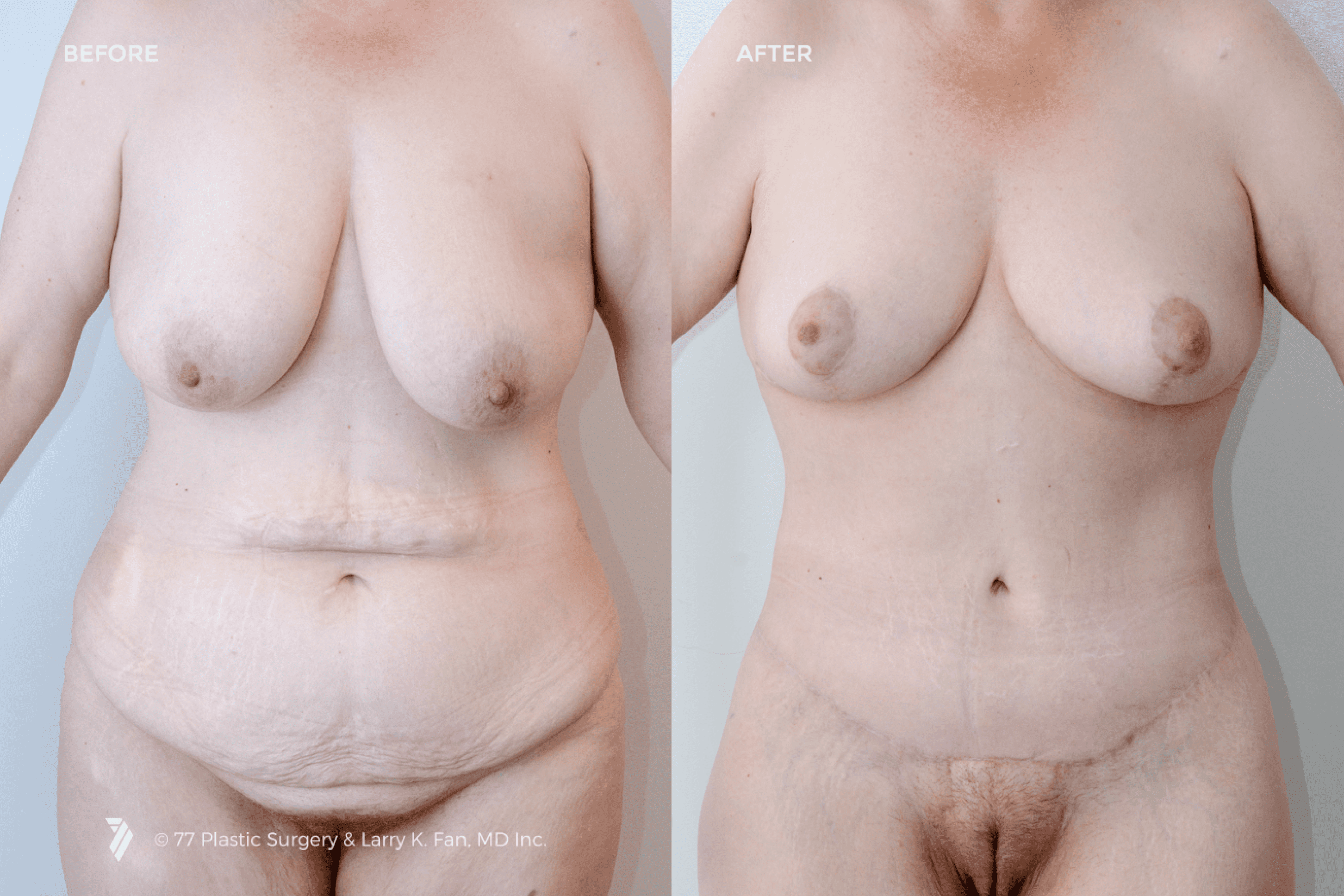 before and after procedure comparison