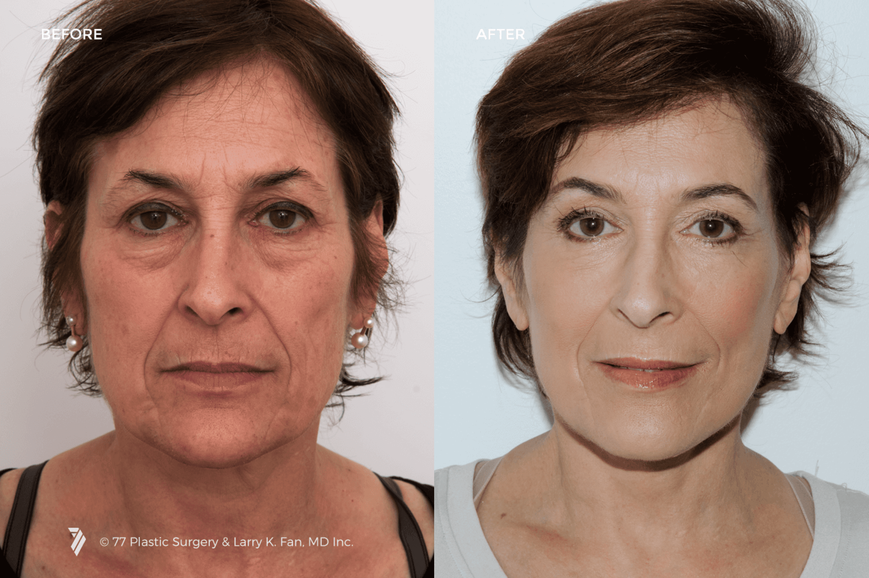 before and after procedure comparison