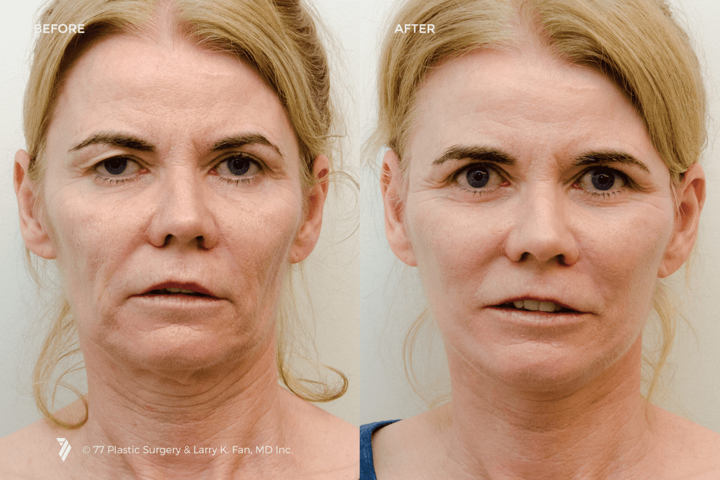 before and after procedure comparison