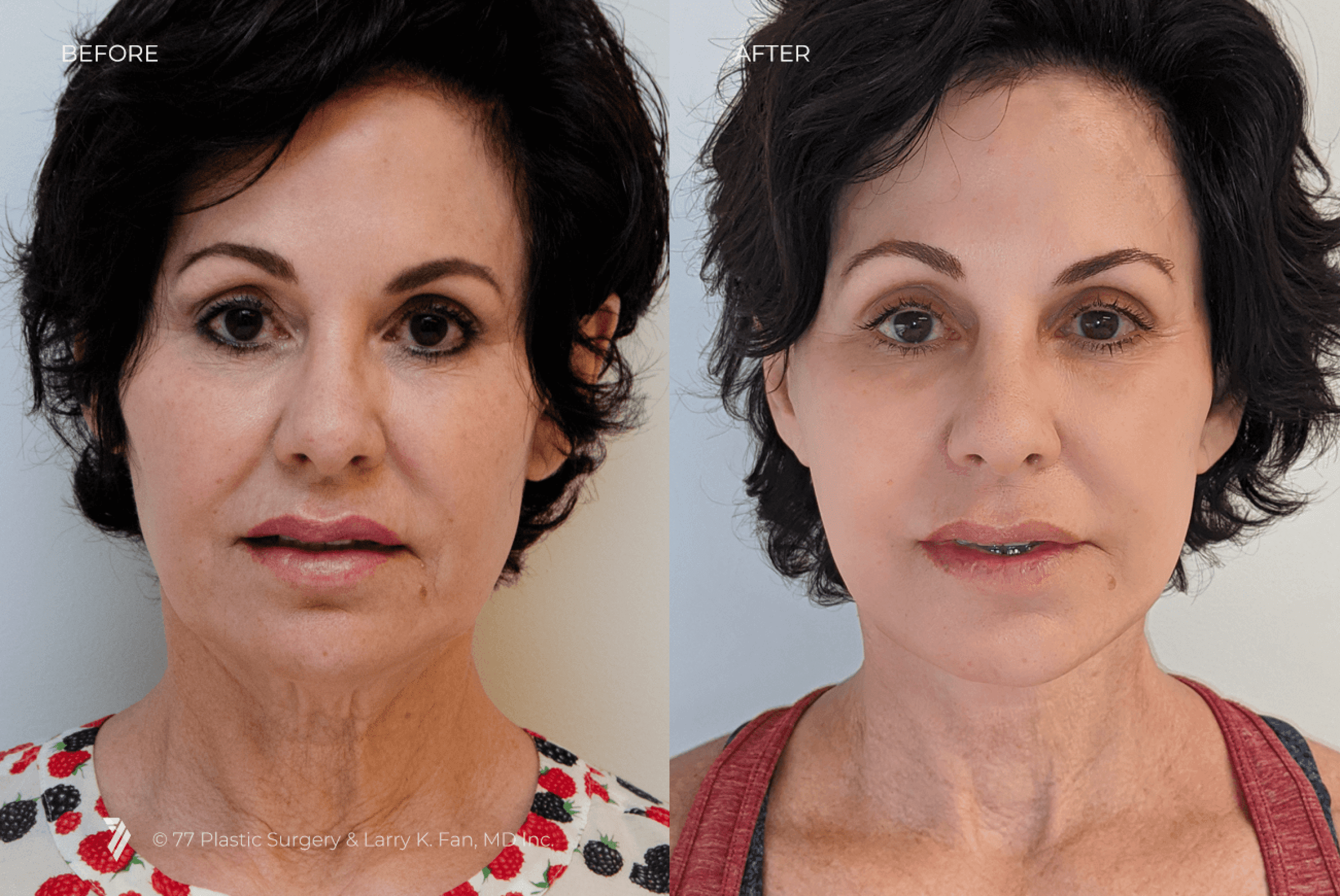 before and after procedure comparison