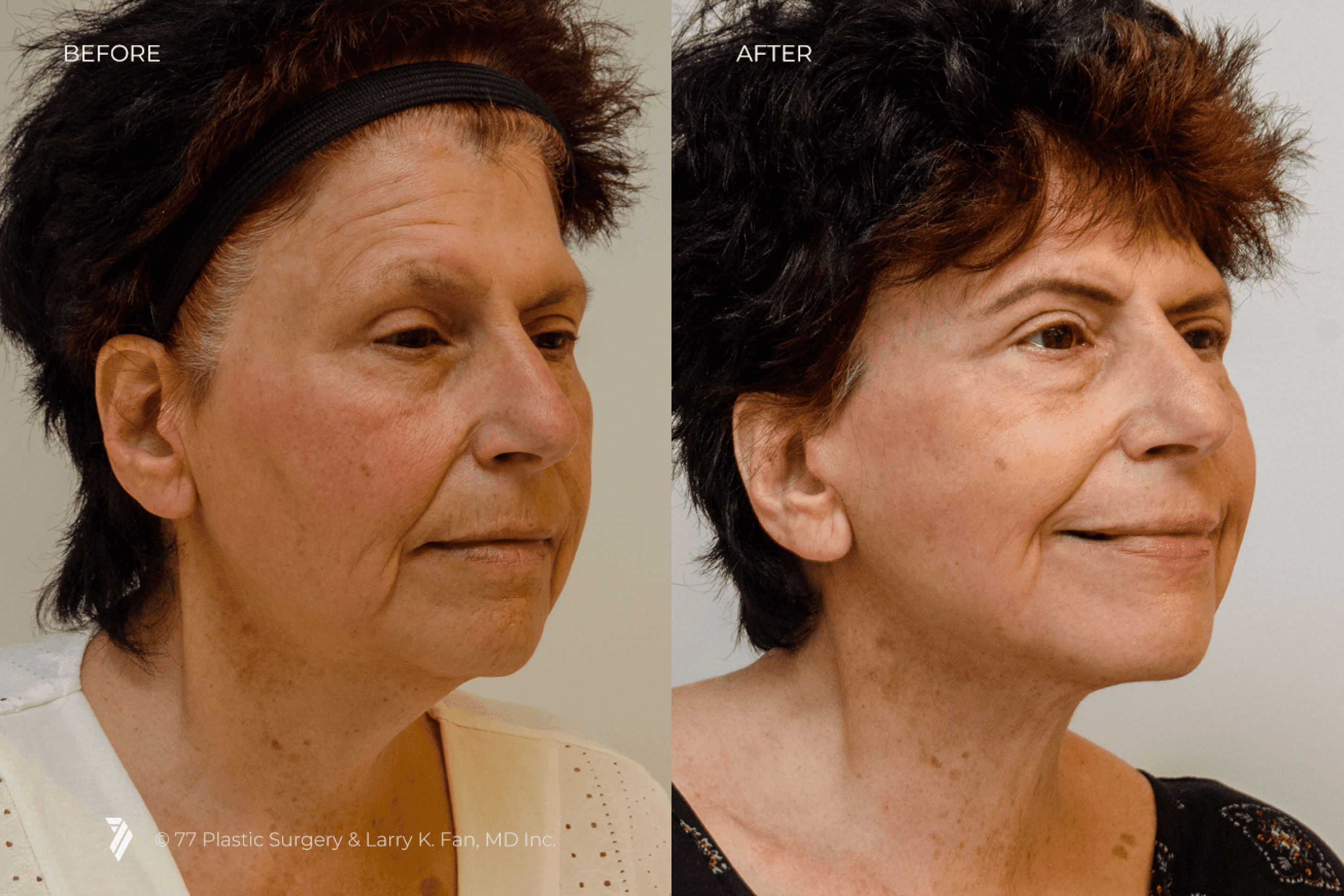 before and after procedure comparison