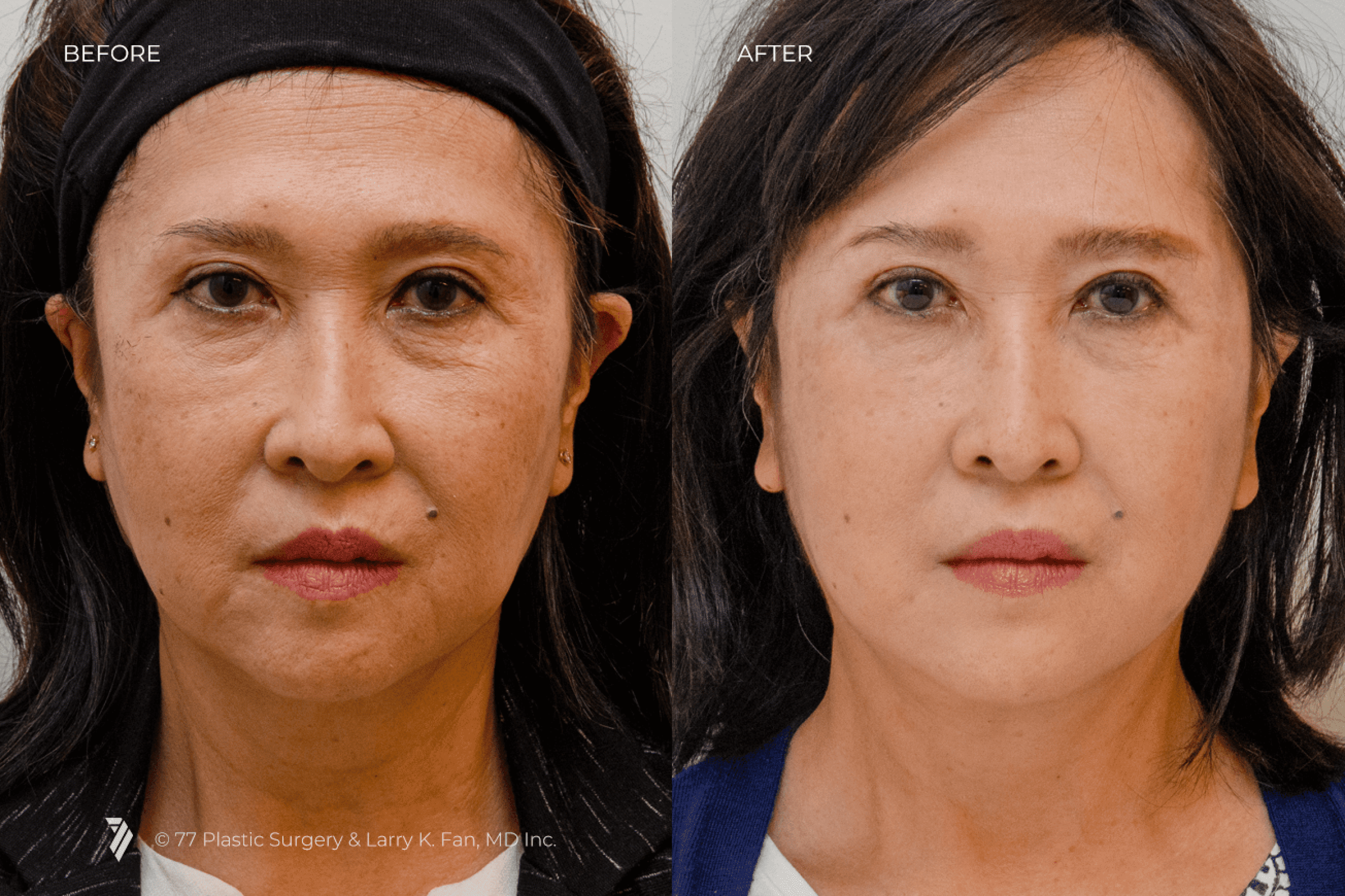 before and after procedure comparison