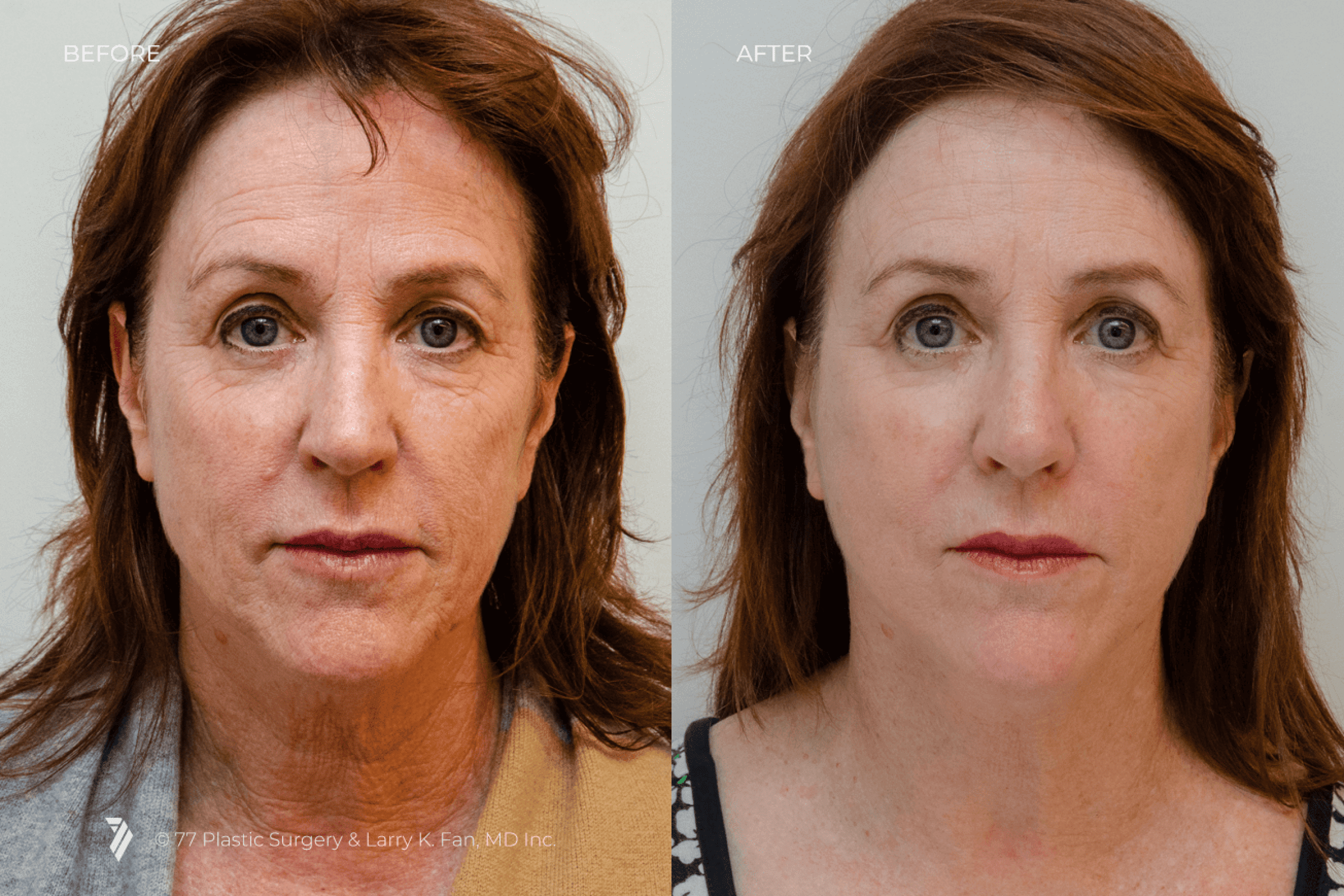 before and after procedure comparison