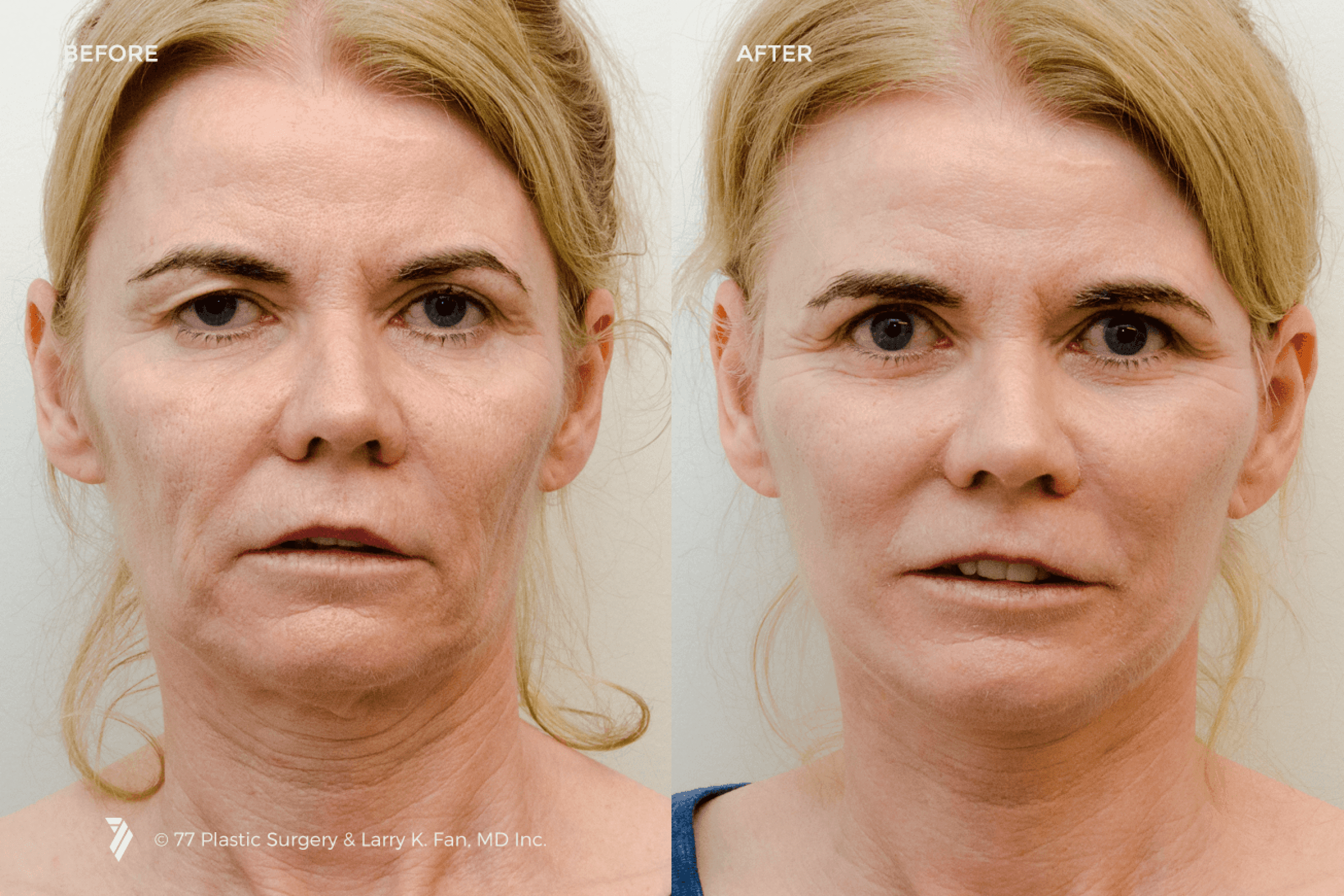 before and after procedure comparison