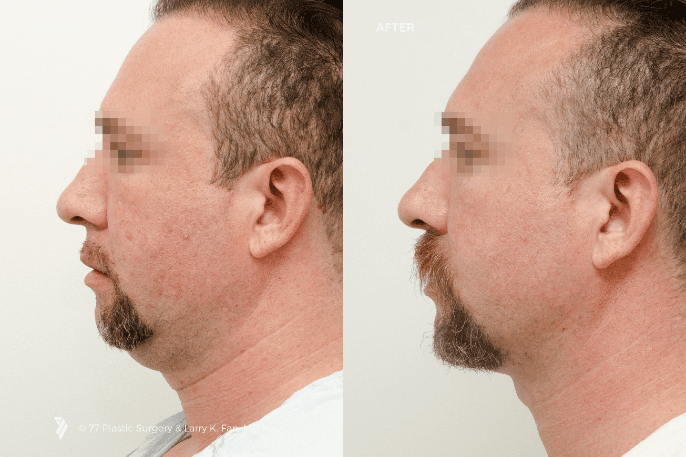 before and after procedure comparison