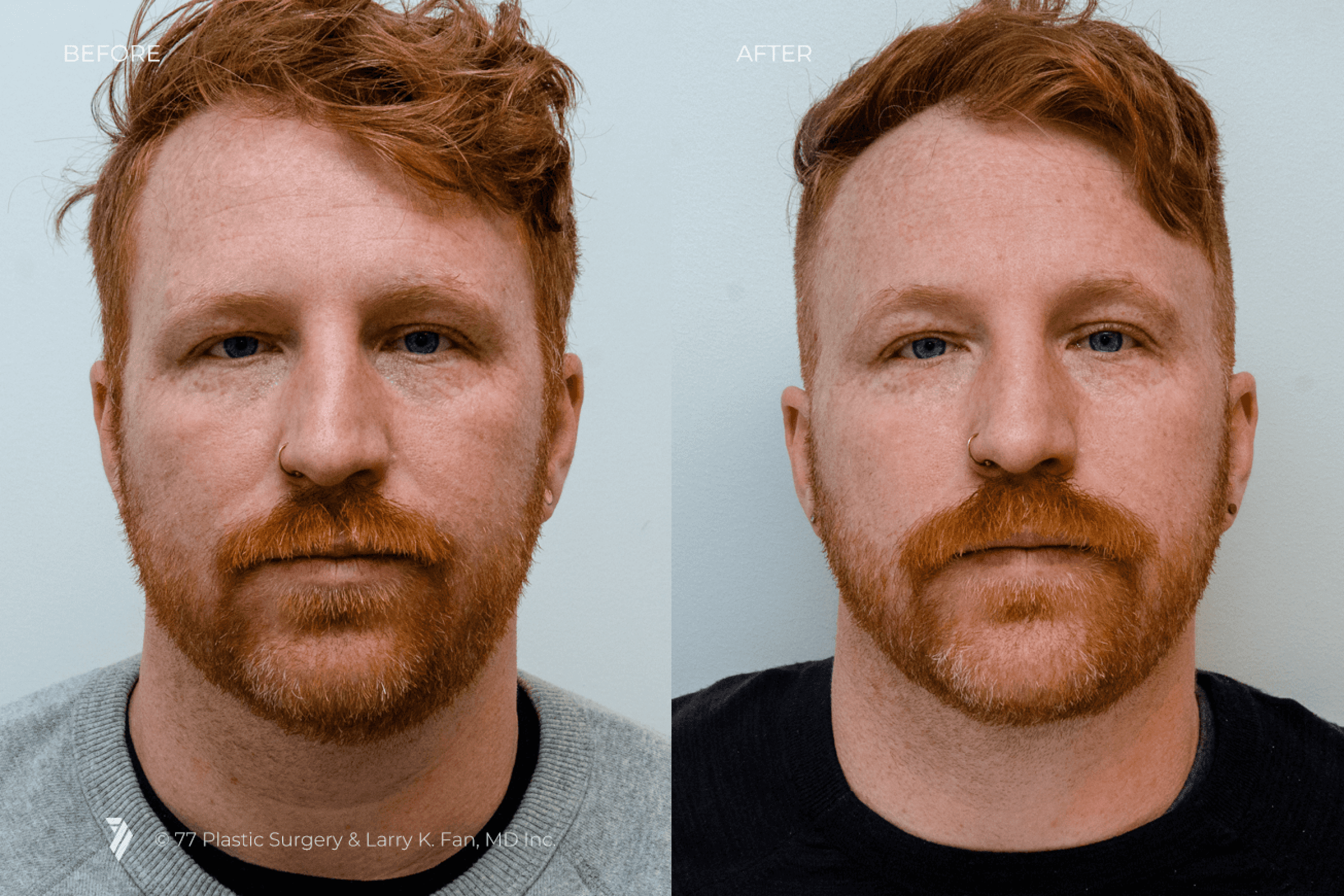 before and after procedure comparison