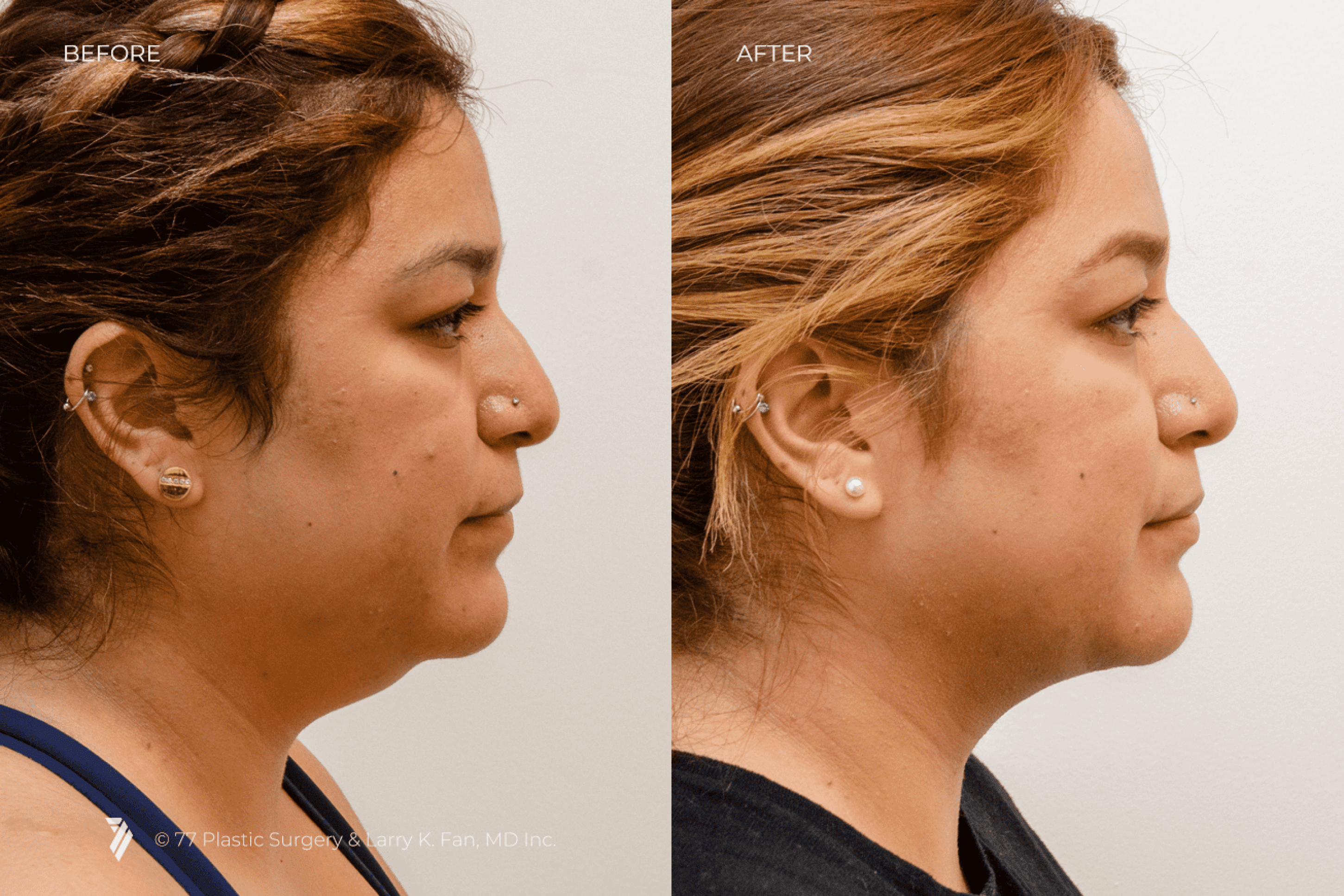 before and after procedure comparison