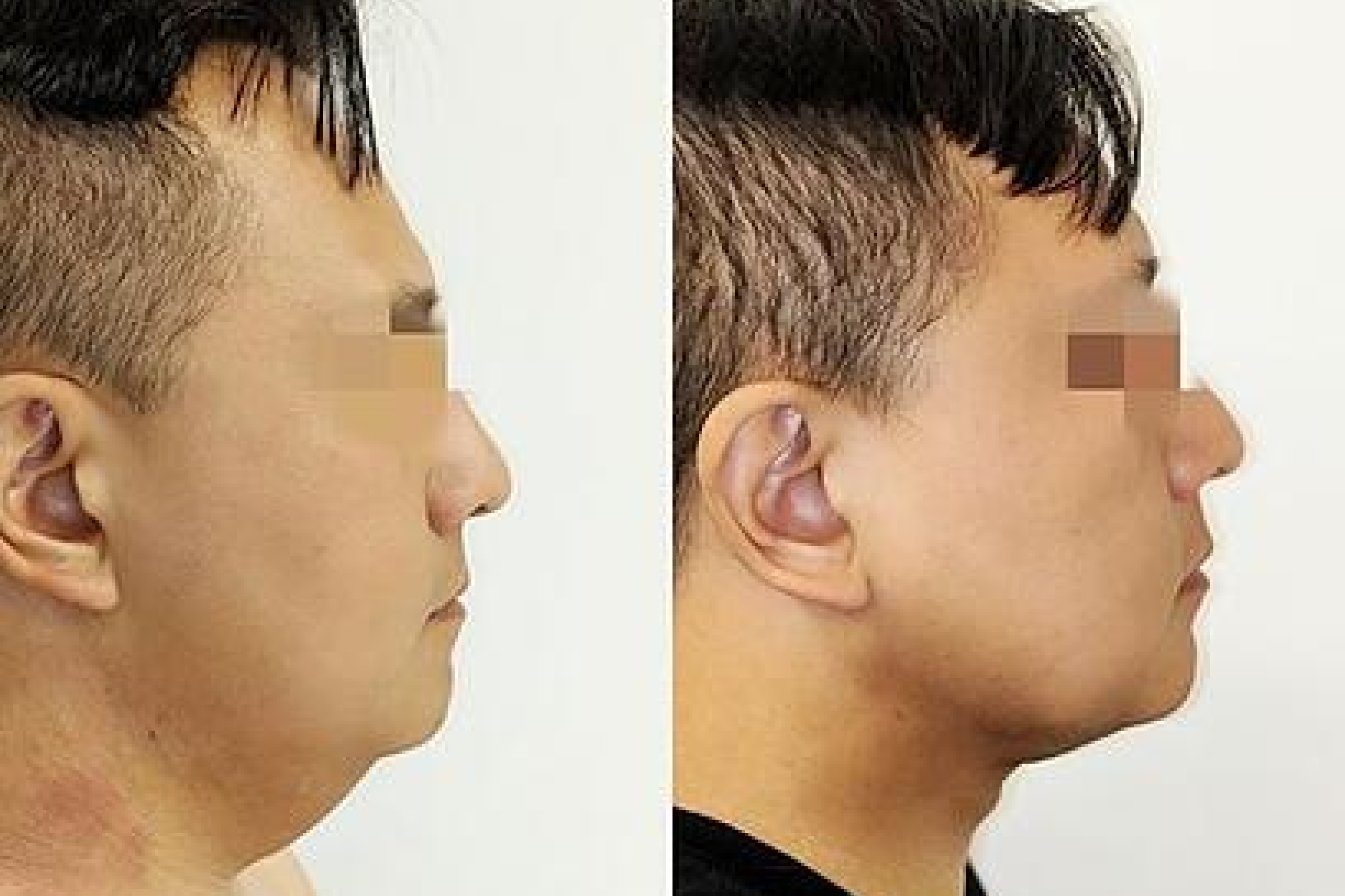 before and after procedure comparison