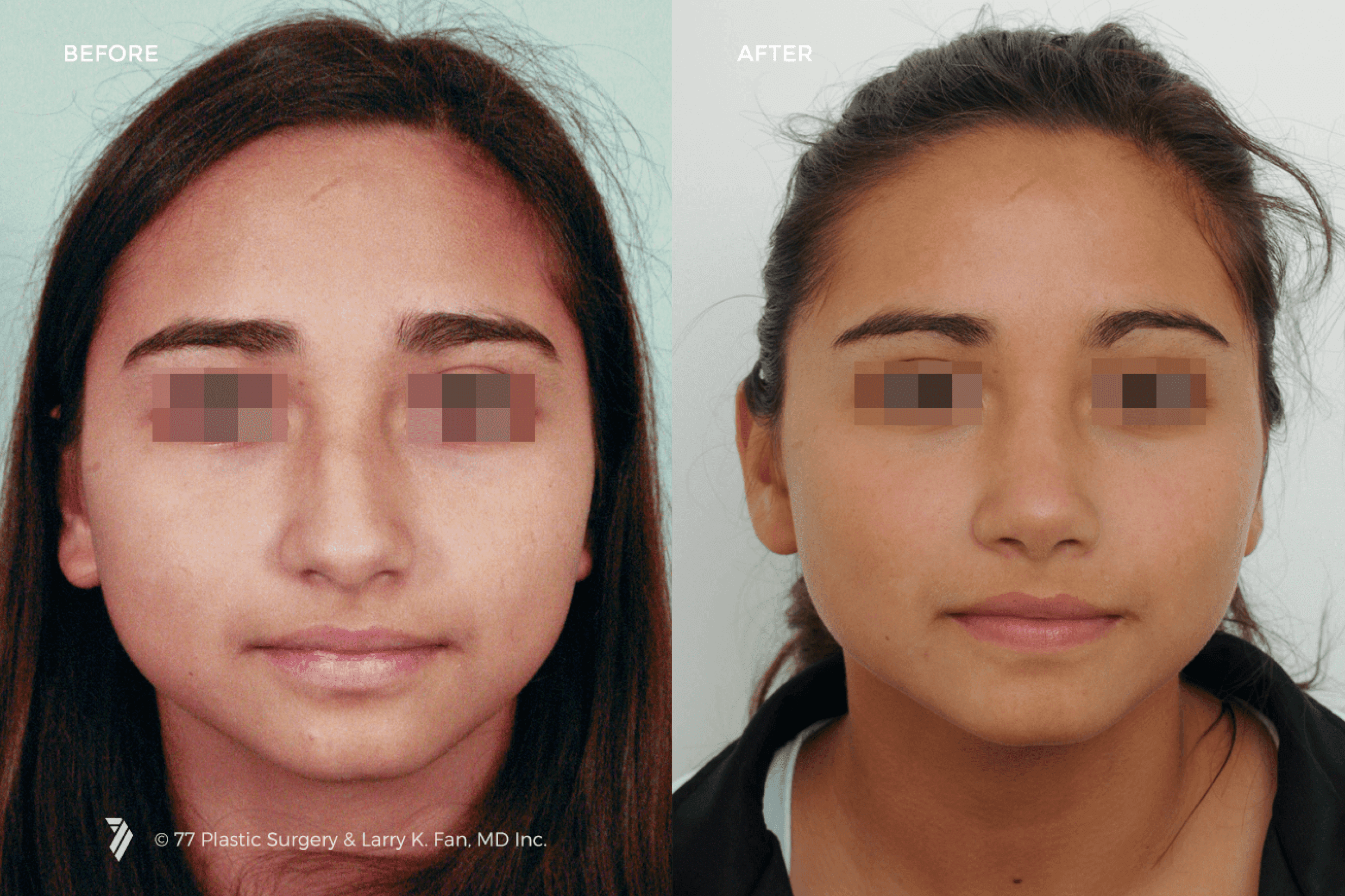 before and after procedure comparison