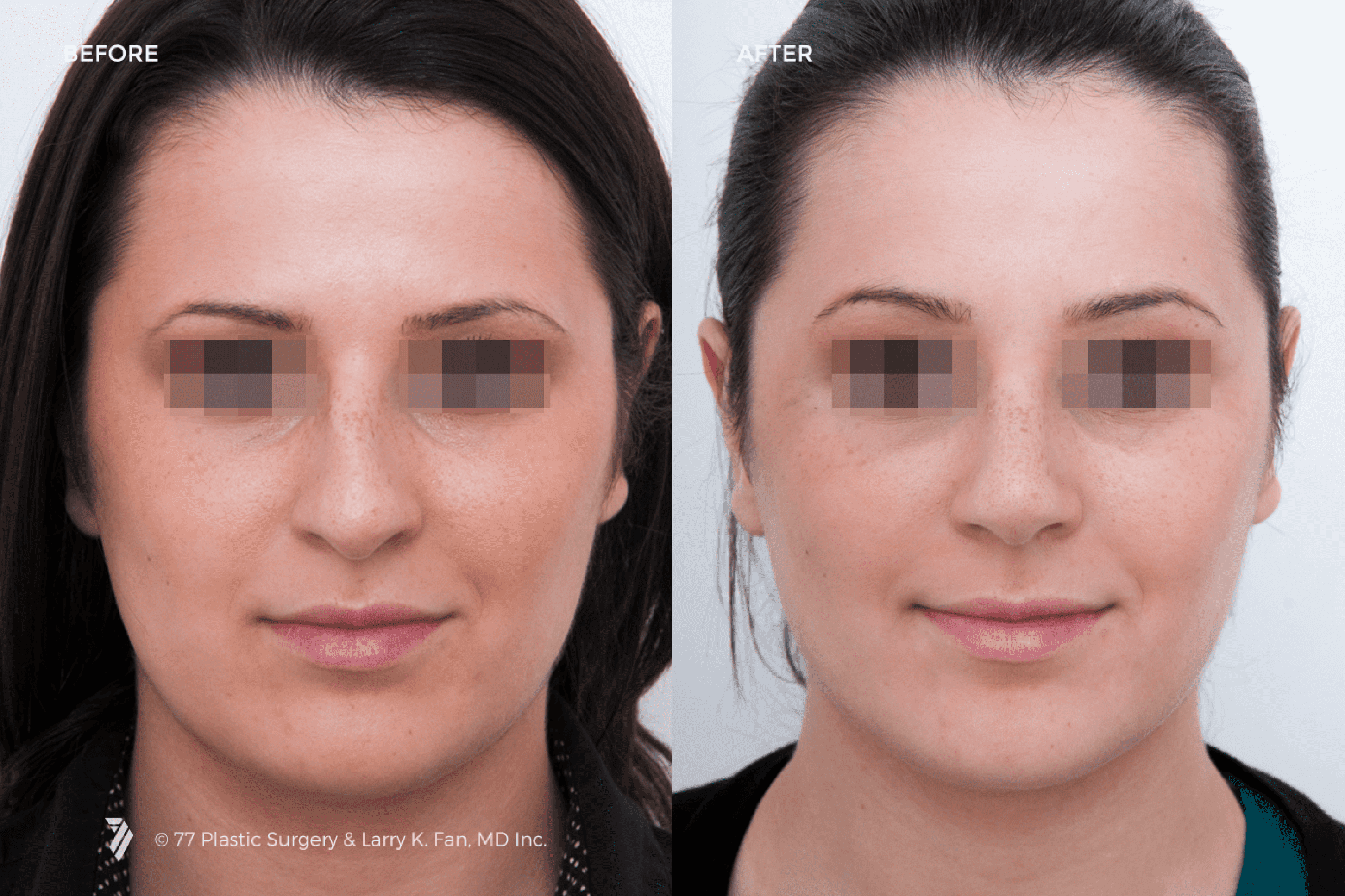 before and after procedure comparison