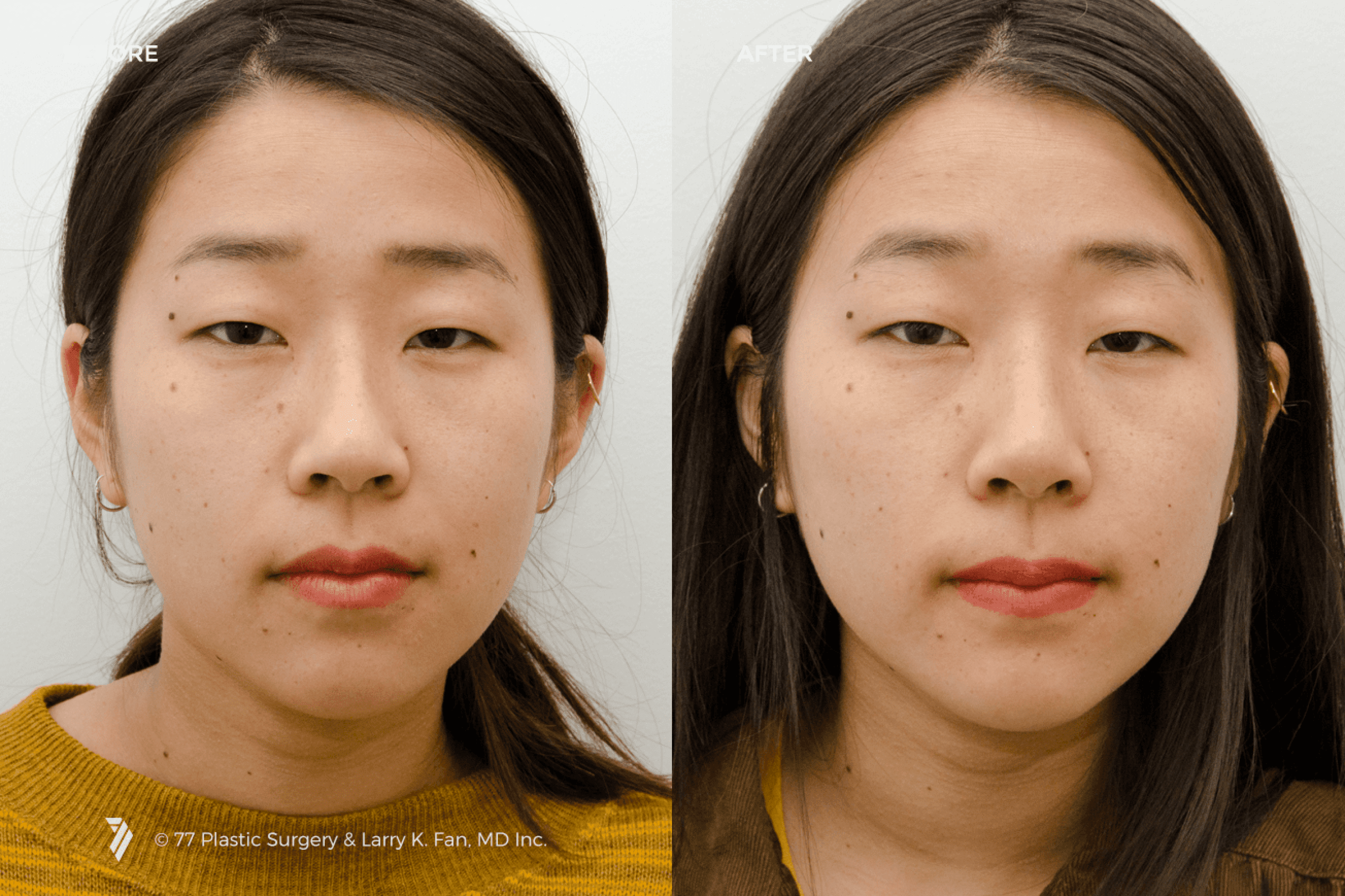 before and after procedure comparison