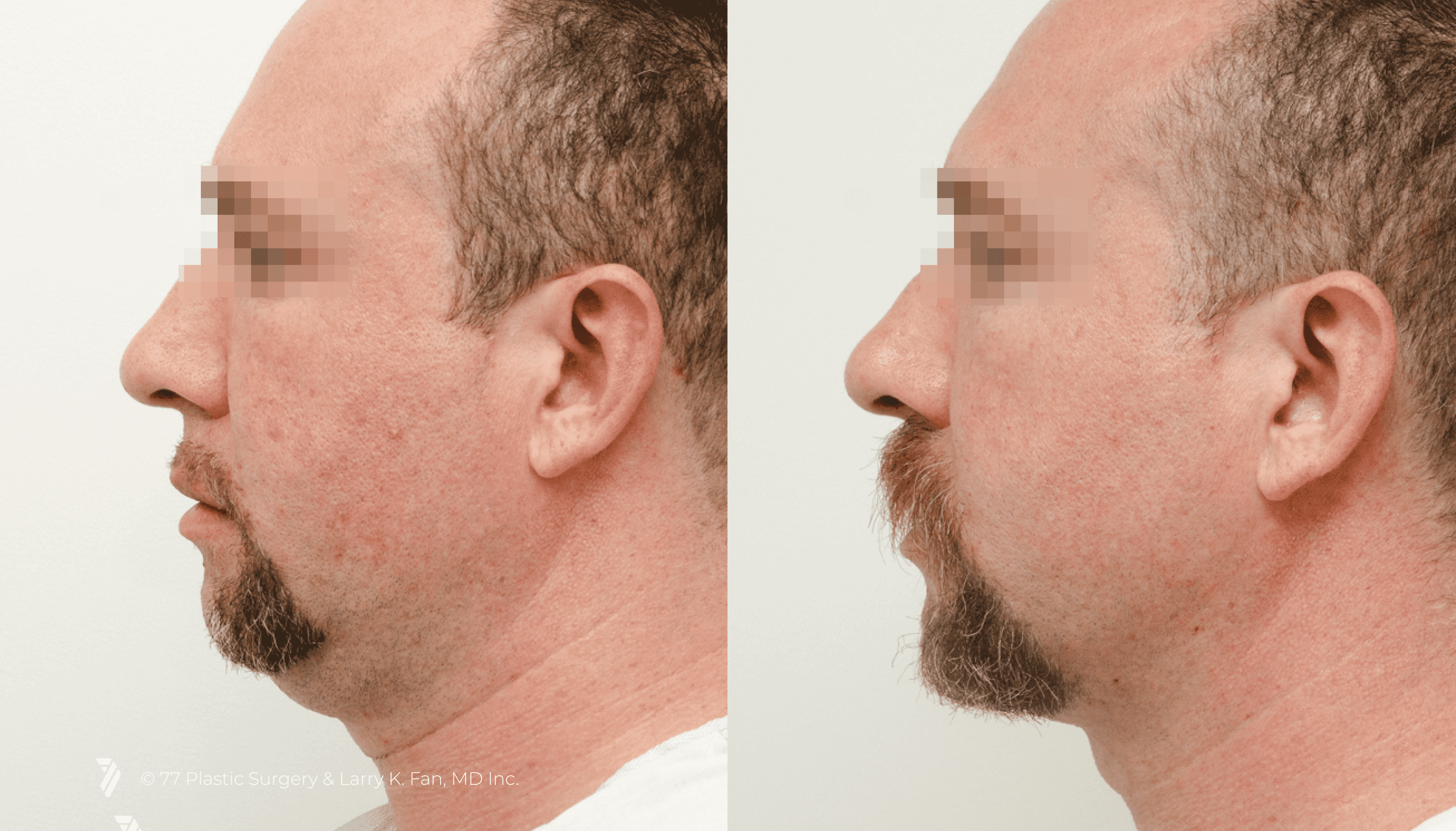 before and after procedure comparison