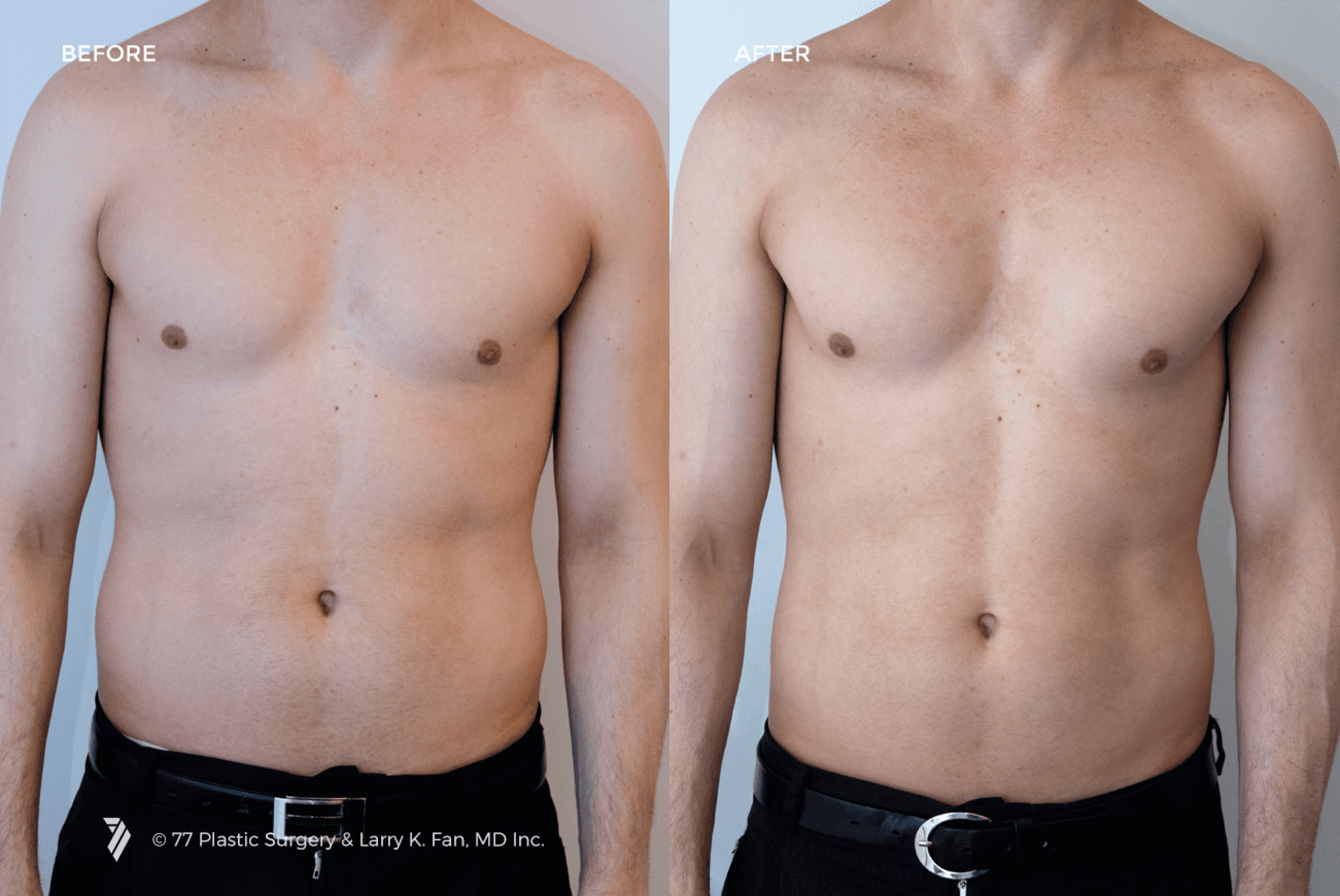 before and after procedure comparison