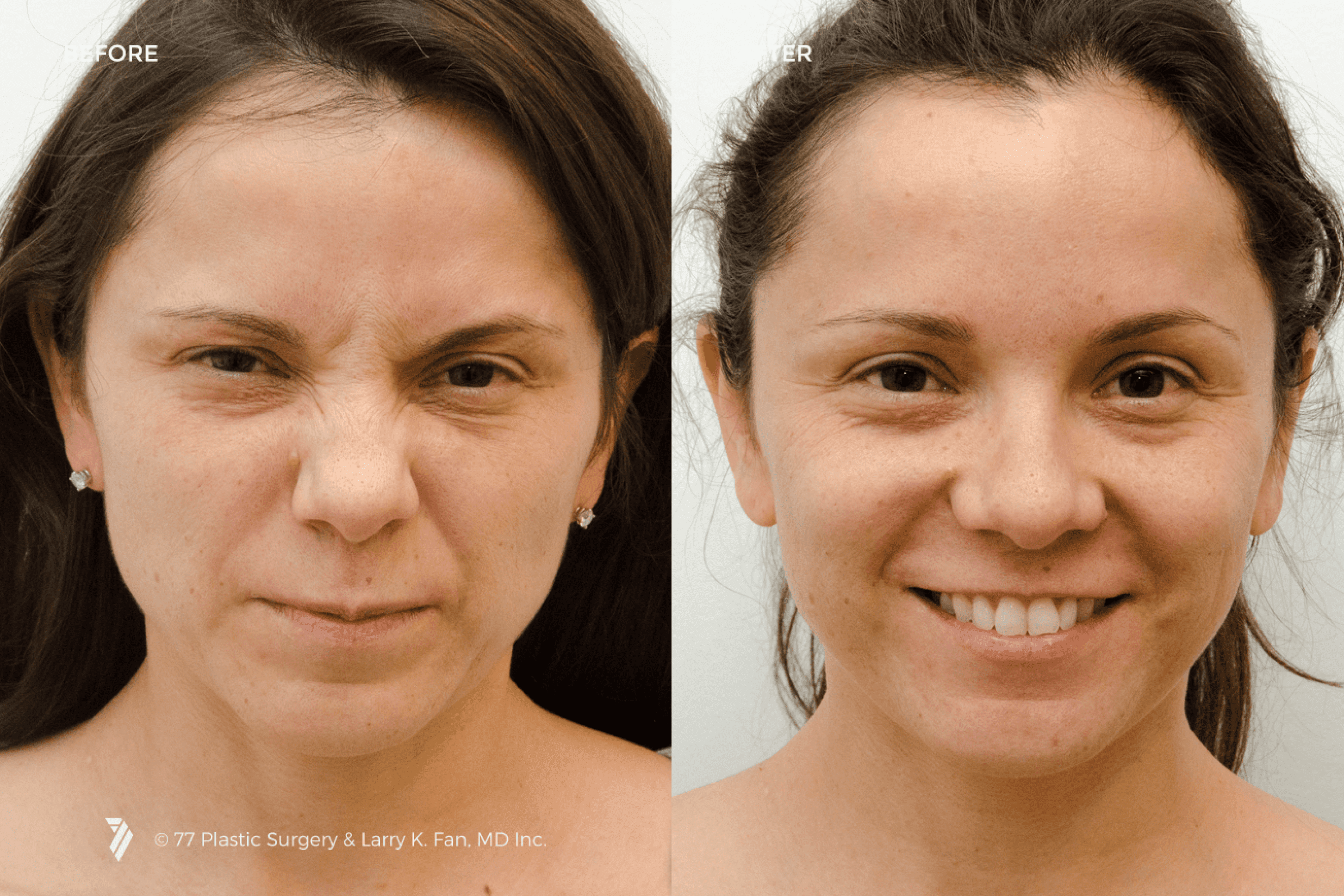 before and after procedure comparison