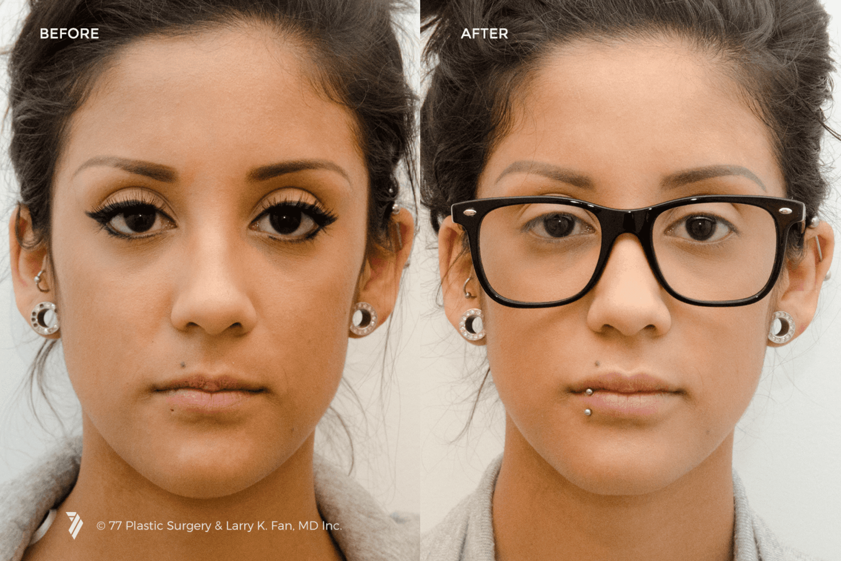 before and after procedure comparison